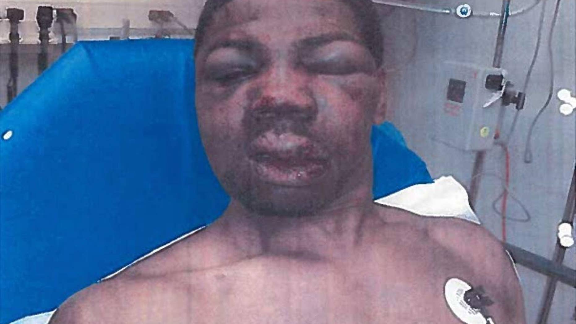 FILE - This April 2012 file photo made by investigators and obtained by The Associated Press from the City of New York Office of Administrative Trials and Hearings, shows inmate Robert Hinton bloodied with a swollen face in a medical clinic in New York, shortly after an April 3, 2012, beating. Police say Friday, Nov. 27, 2015, that Robert Hinton was shot in the head and stomach outside a public housing complex Thanksgiving night. (City of New York Office of Administrative Trials and Hearings via AP, File)