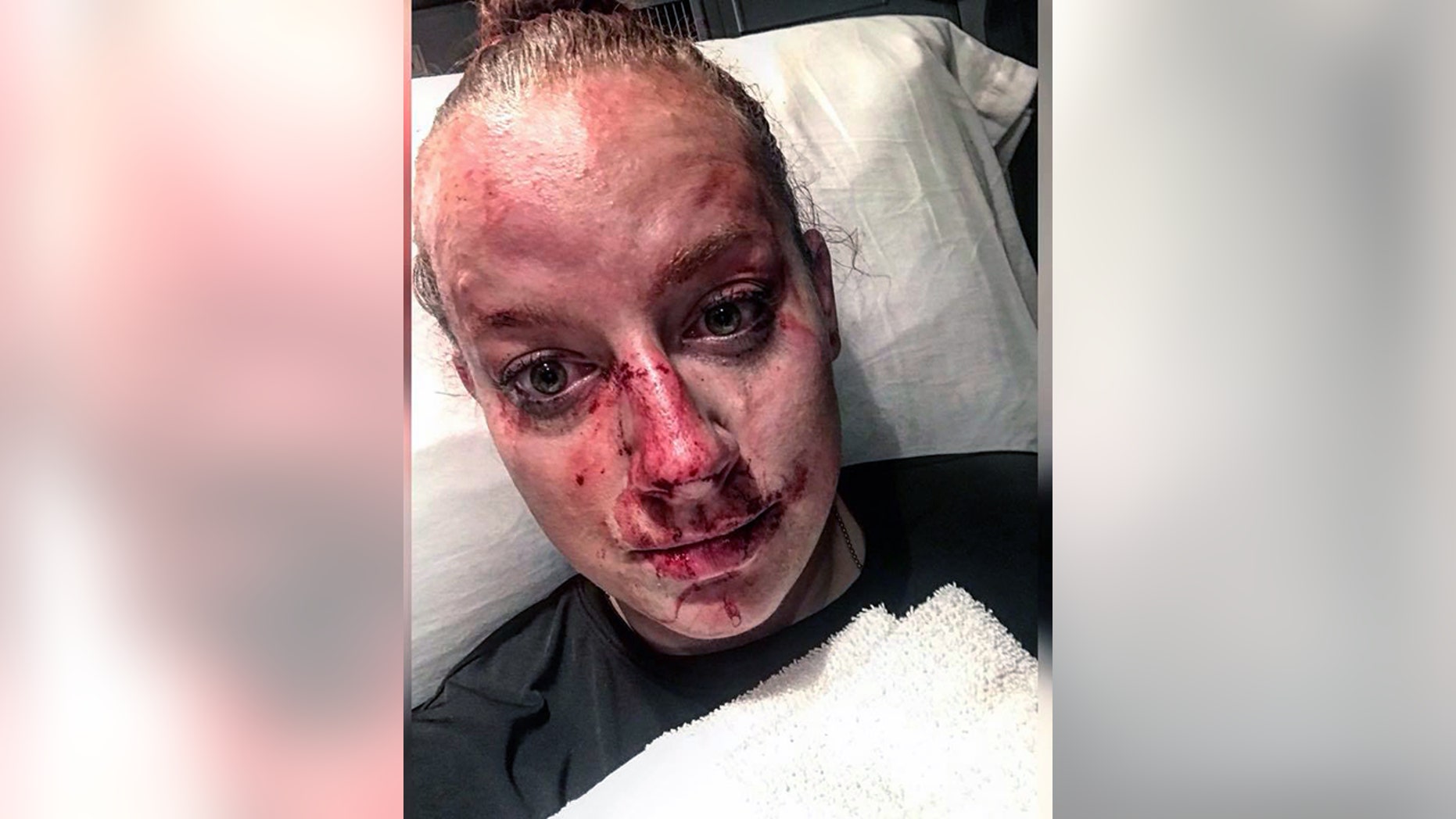 Brooke County (W.Va.) Sheriff's Deputy Kristen Richmond posted this photo of her injuries after a fight with a suspect early Friday.