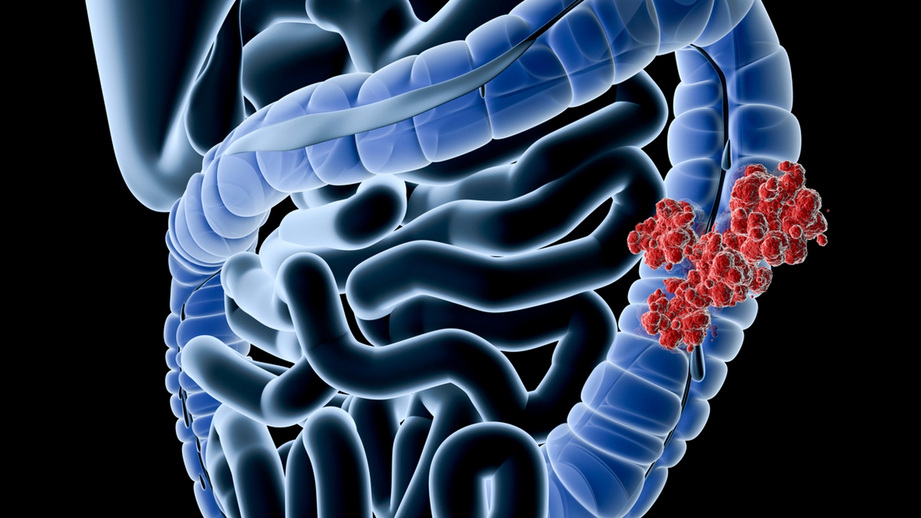 "Digital medical illustration: Perspective x-ray view of human colon with tumor. Anatomically correct. Isolated on black.For other cancer related-and general anatomy images, see:"