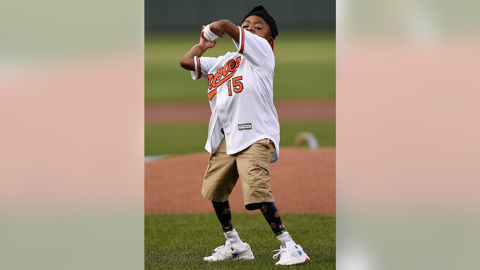 Zion Harvey is the first child to receive a bilateral hand transplant.