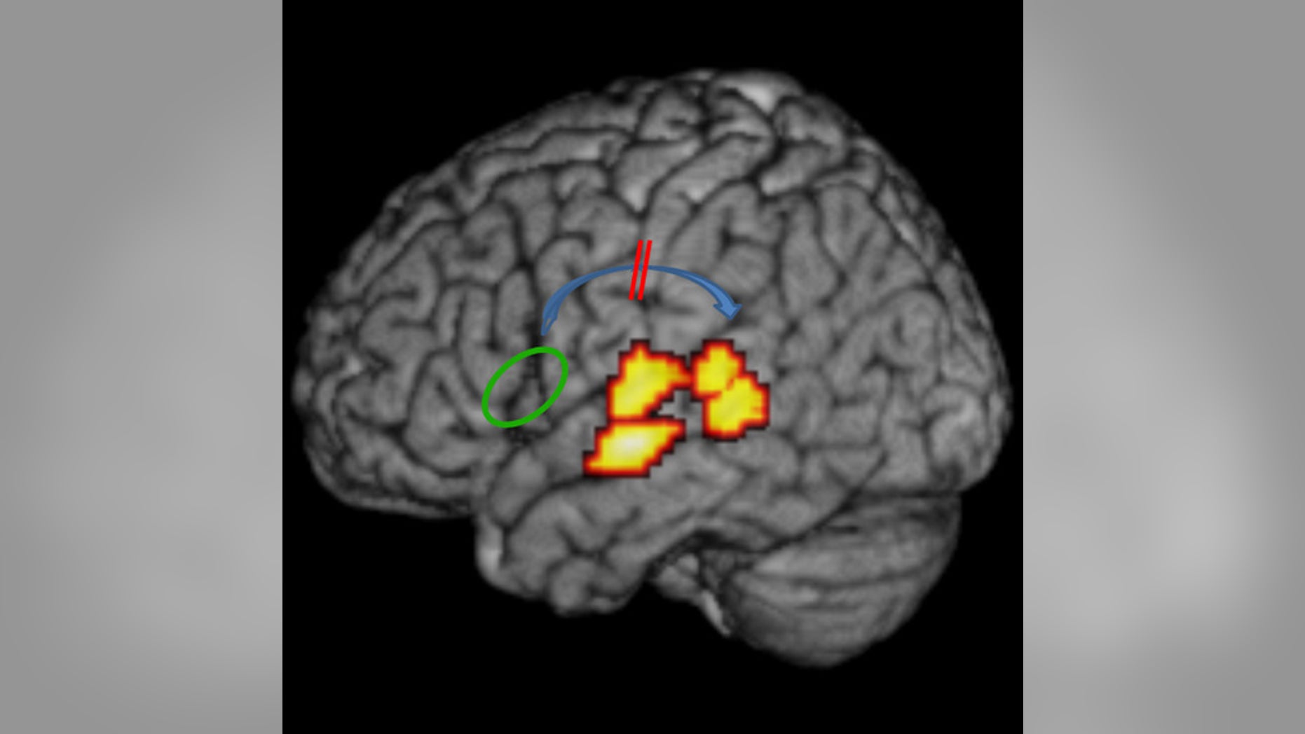 The researchers showed that the functional and structural connection (blue arrow) between frontal (green) and temporal (red-yellow) language areas is impaired in individuals with dyslexia.