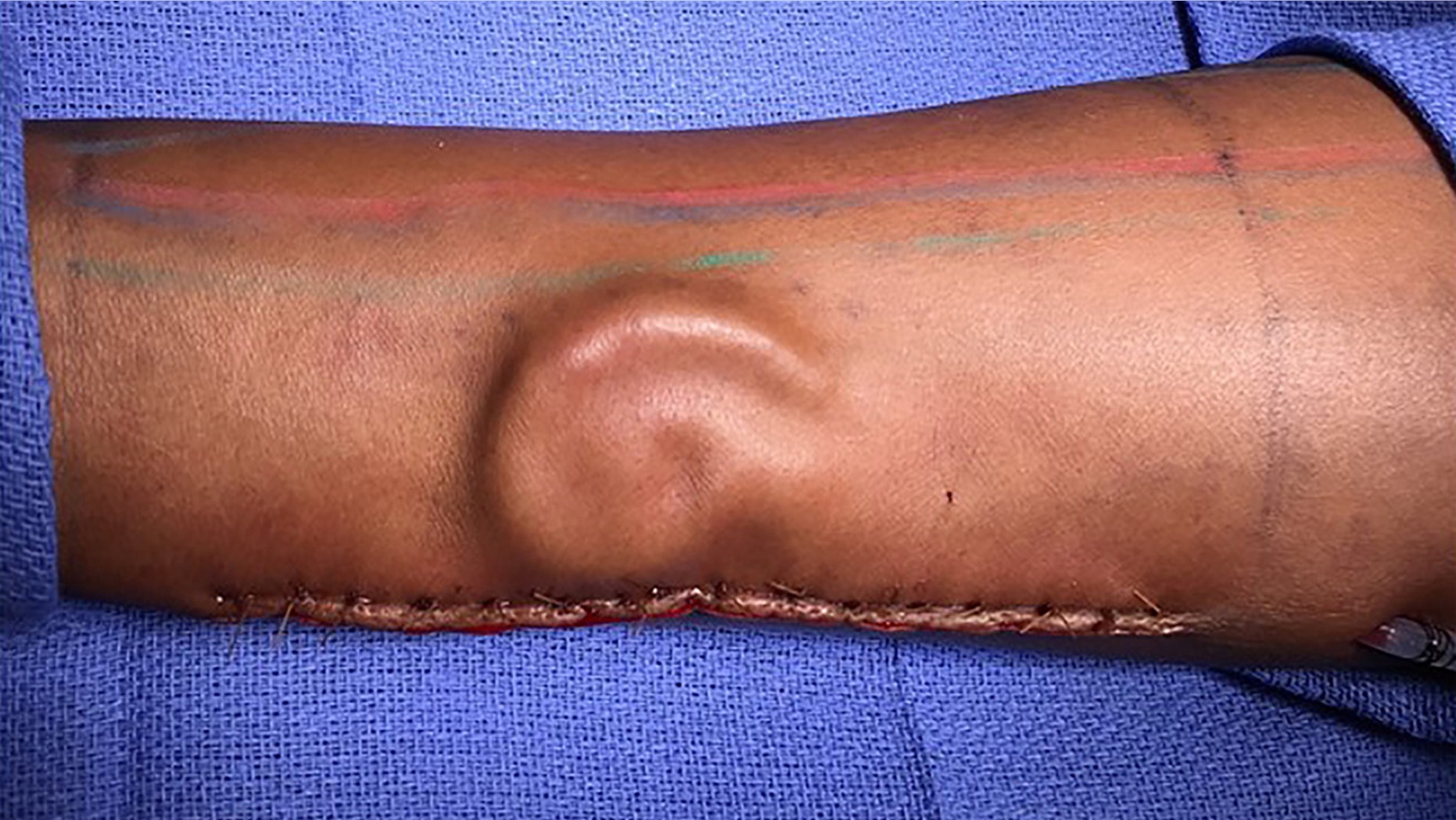 Physicians at William Beaumont Army Medical Center reportedly did a total ear reconstruction surgery on a soldier who lost the use of her own after a car accident.