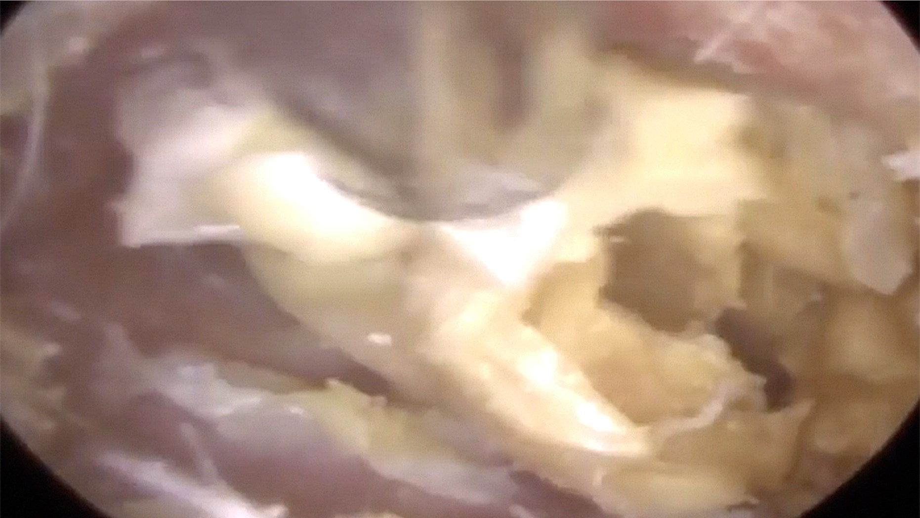 A still from Raithatha's video shows how badly the woman's ear canal was backed up.