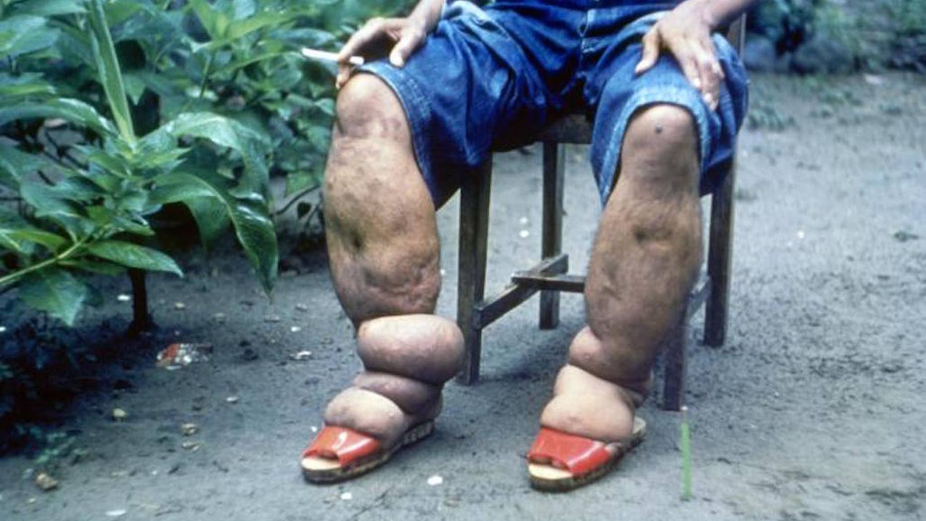 This CDC photo, from 1962, shows a man in the Philippines with elephantiasis of the lower limbs.