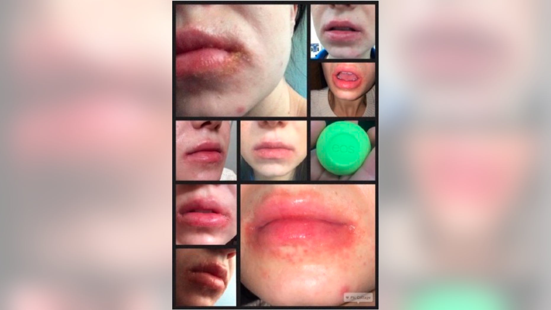 Users claim EOS lip balm left their lips cracked and flaky.