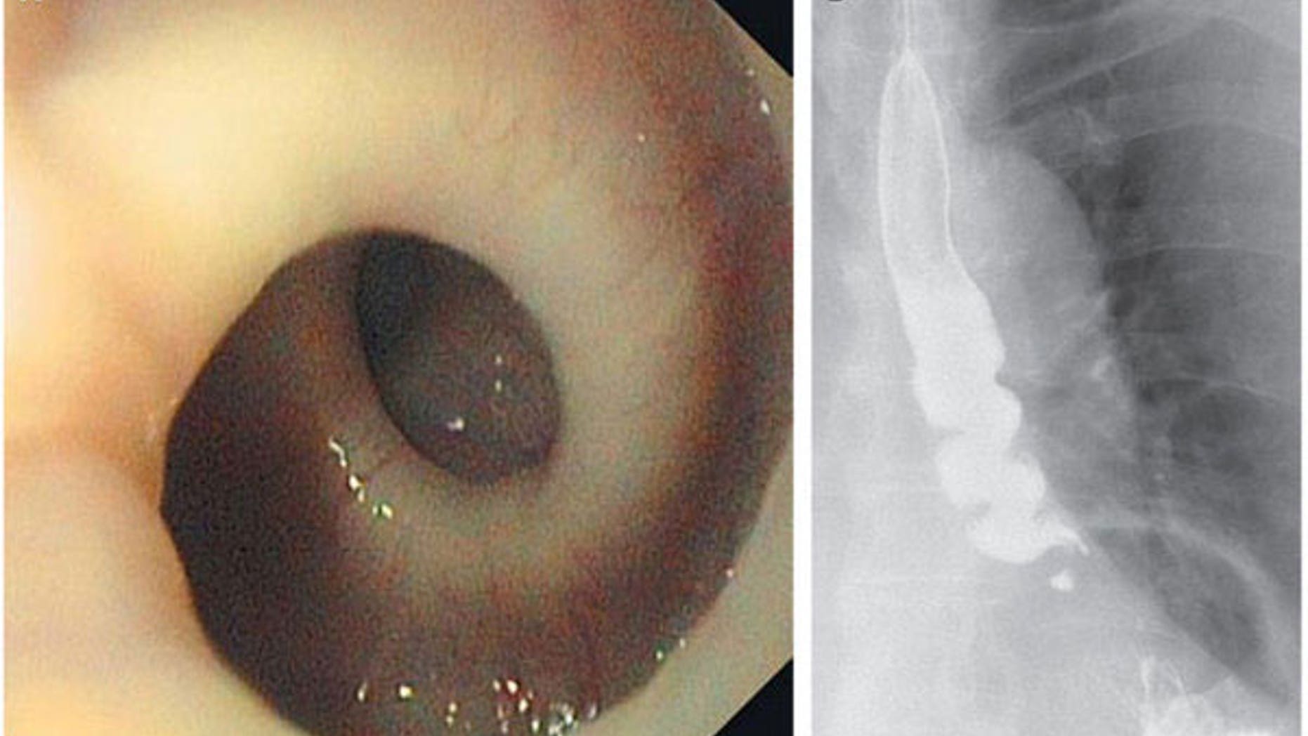 An 87-year-old woman had an esophagus that twisted itself into a corkscrew shape whenever she swallowed. Credit: New England Journal of Medicine ©2013.