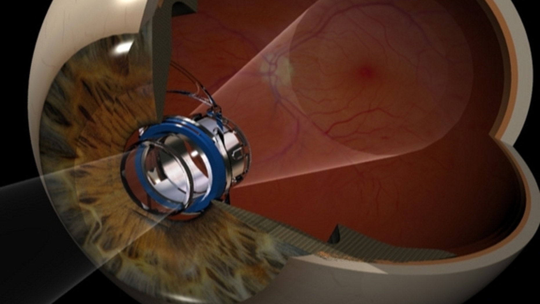 The implantable telescope technology reduces the impact of the central vision blind spot from advanced macular degeneration. The telescope implant projects the objects the patient is looking at on to the healthy area of the light-sensing retina