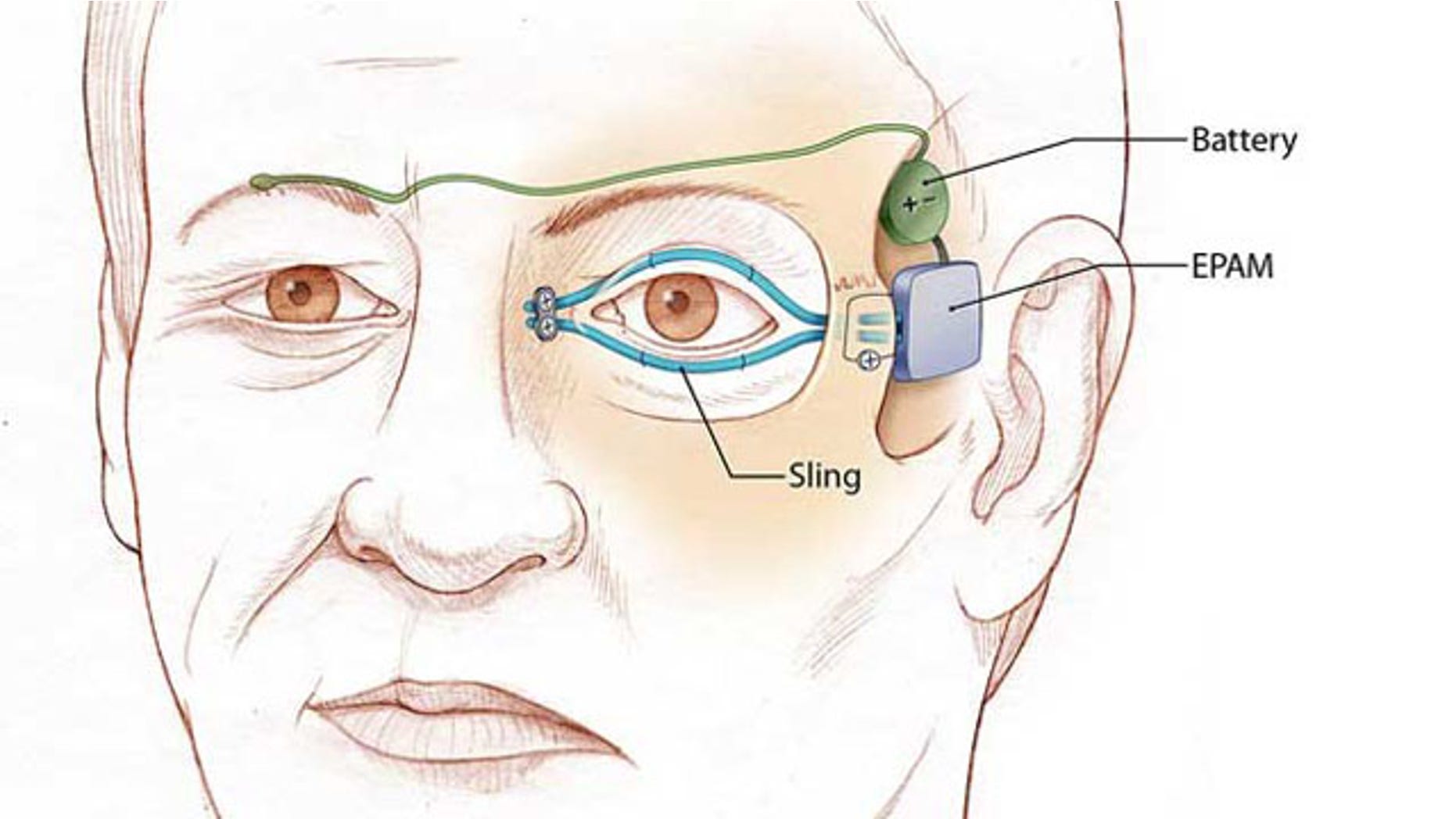 Illustration of left eyelid "sling" that is attached to an artificial muscle. The power supply and artificial muscle are implanted in the temple. When the normal right eyelid blinks, the electrical sensor (green) sends a signal to the battery to activate the artificial muscle.