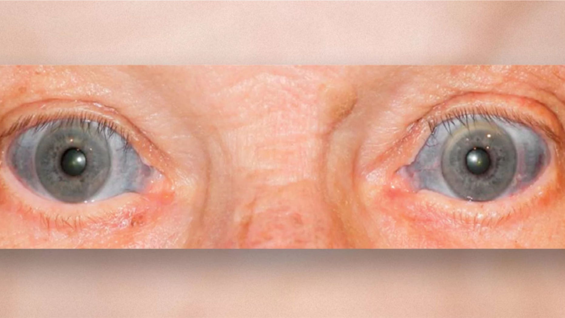 Why Did The Whites Of This Man s Eyes Turn Blue Fox News why-did-the-whites-of-this-man-s-eyes-turn-blue-fox-news