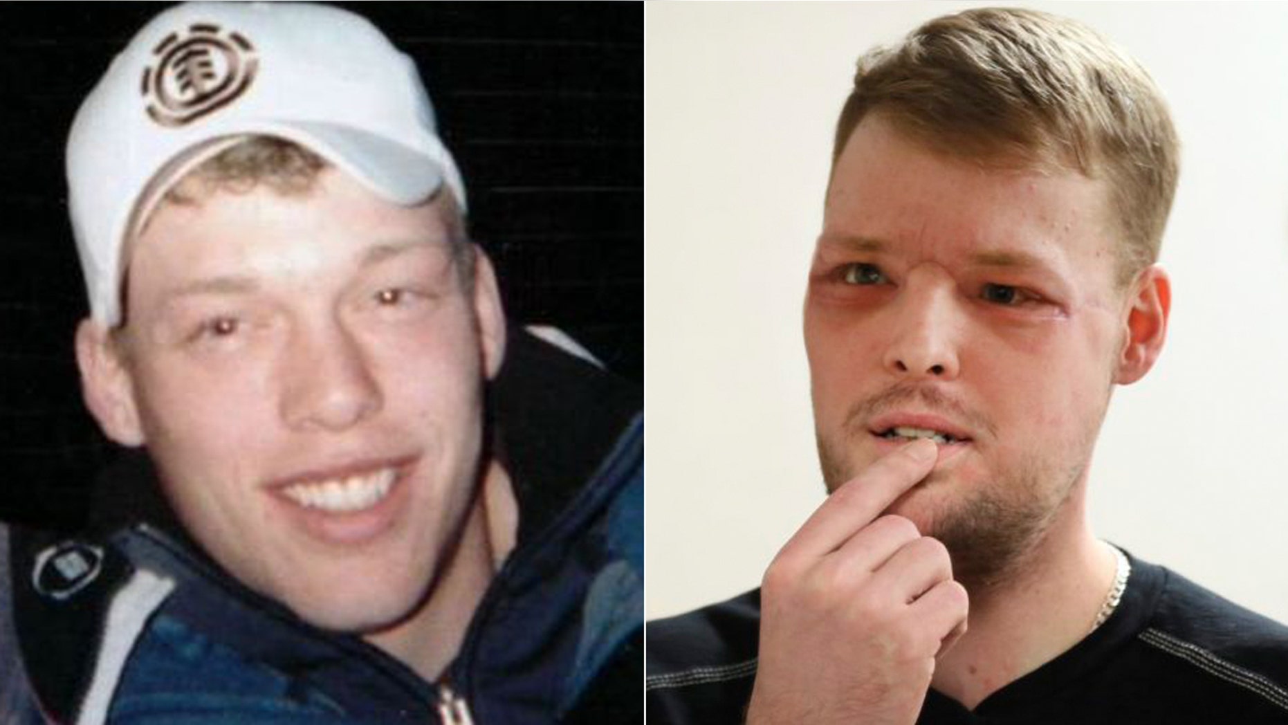 Andy Sandness is pictured left, before his injury, and right, after his face transplant.