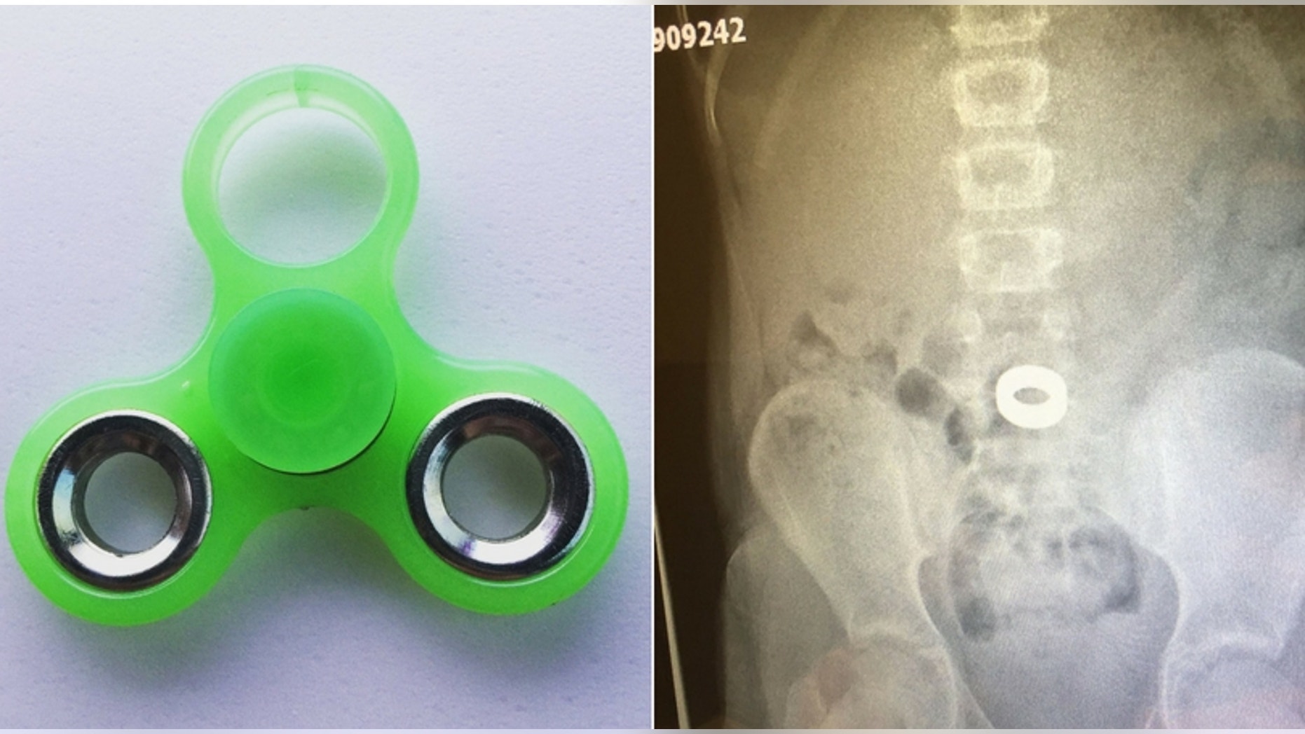 The Indiana girl was playing with her fidget spinner when a metal piece flew off and went into her mouth. (Decatur Township Fire Department)