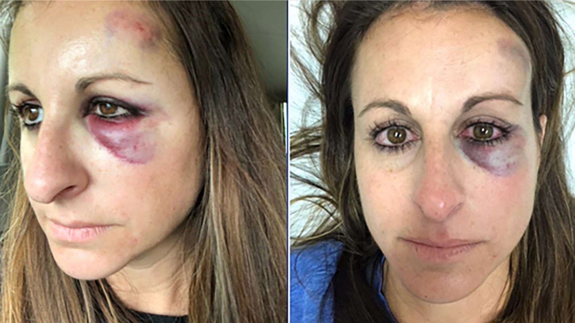 Sabrina Pattie was hit in the face by a puck at a Tampa Bay Lightning playoff game.