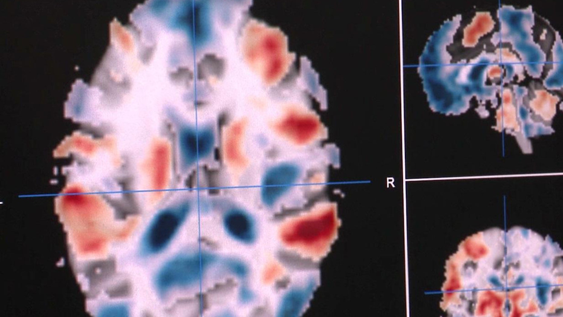 An example of brain activation from the Neurovault database. Red areas are activated by a particular task, blue areas are deactivated.