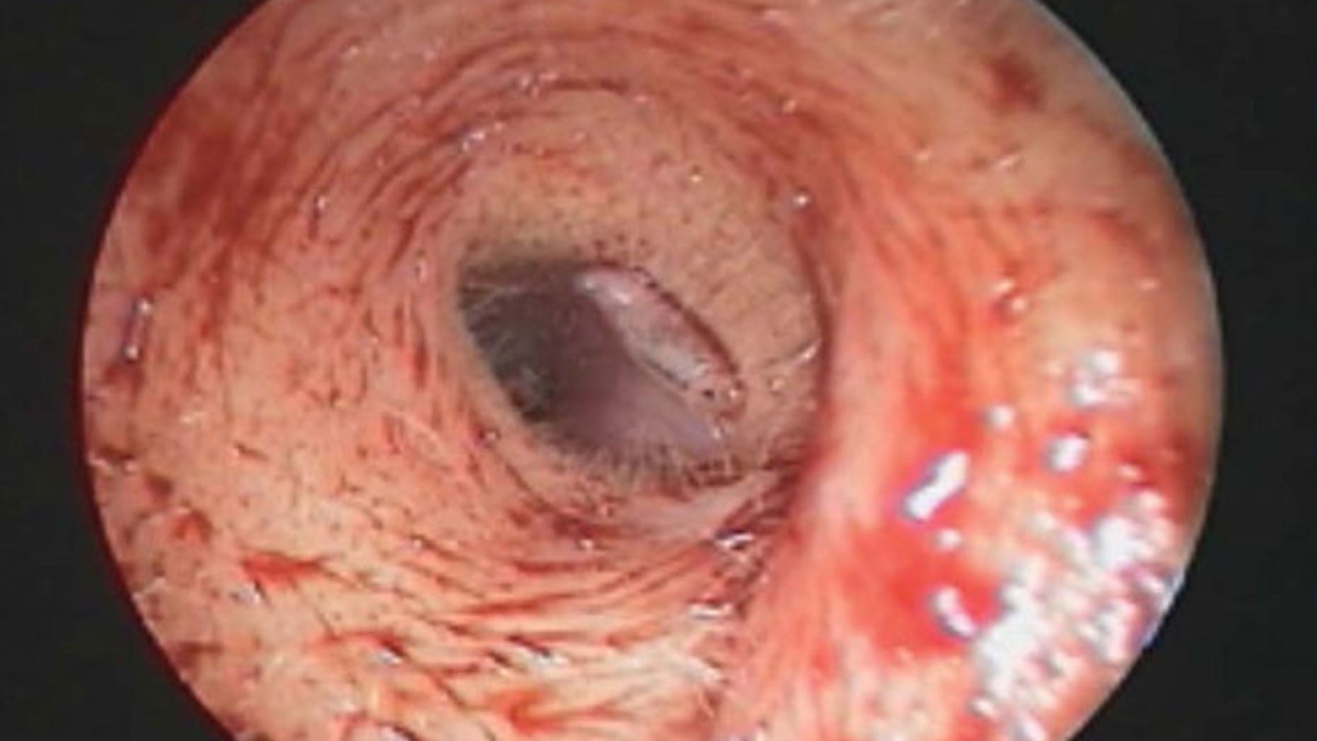 A woman's ear pain was the result of a fruit fly larva moving in her ear. Above, an image of the larva.