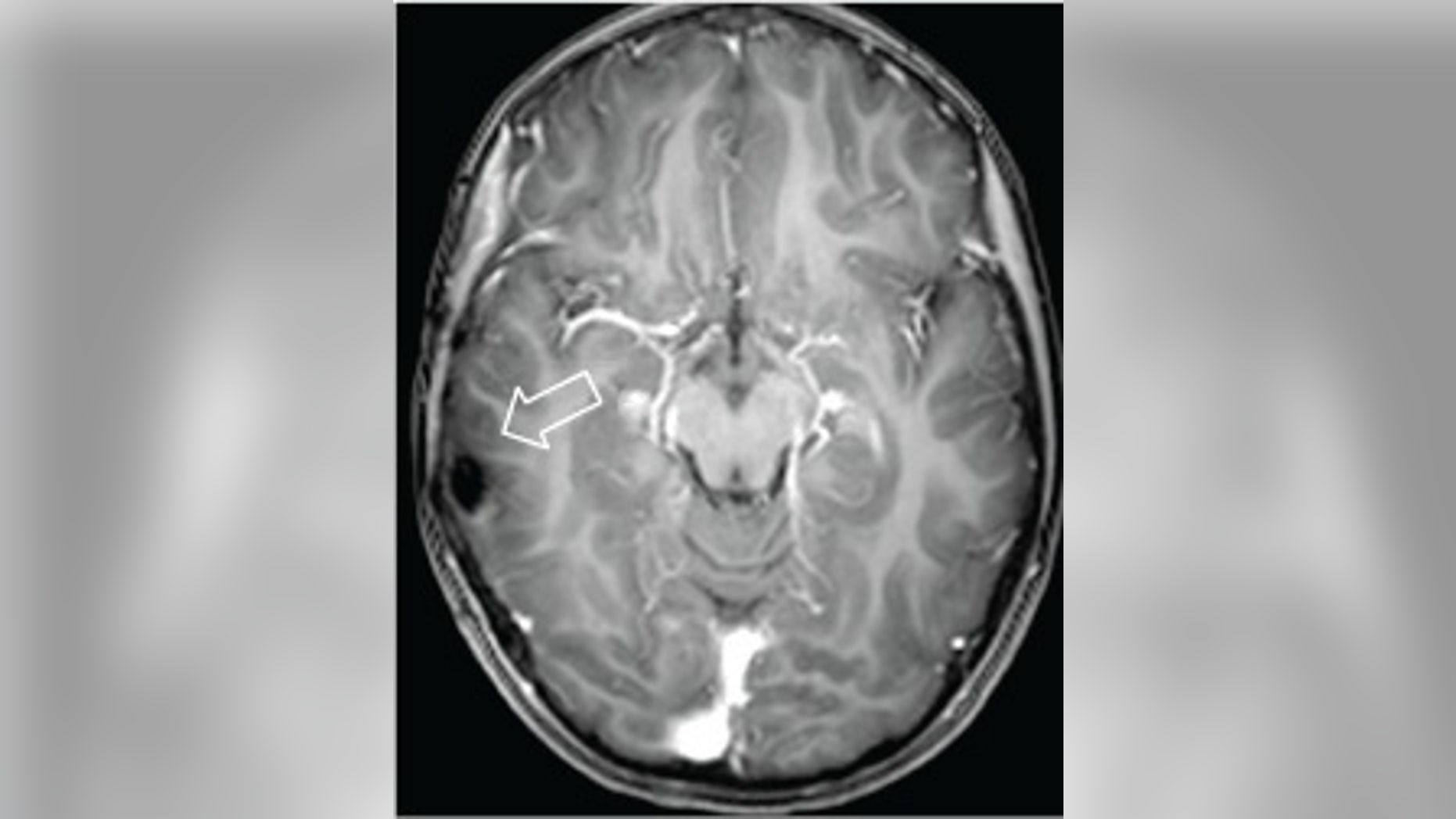 A brain tumor from a young girl with uncontrollable laughter is shown in this MRI scan.