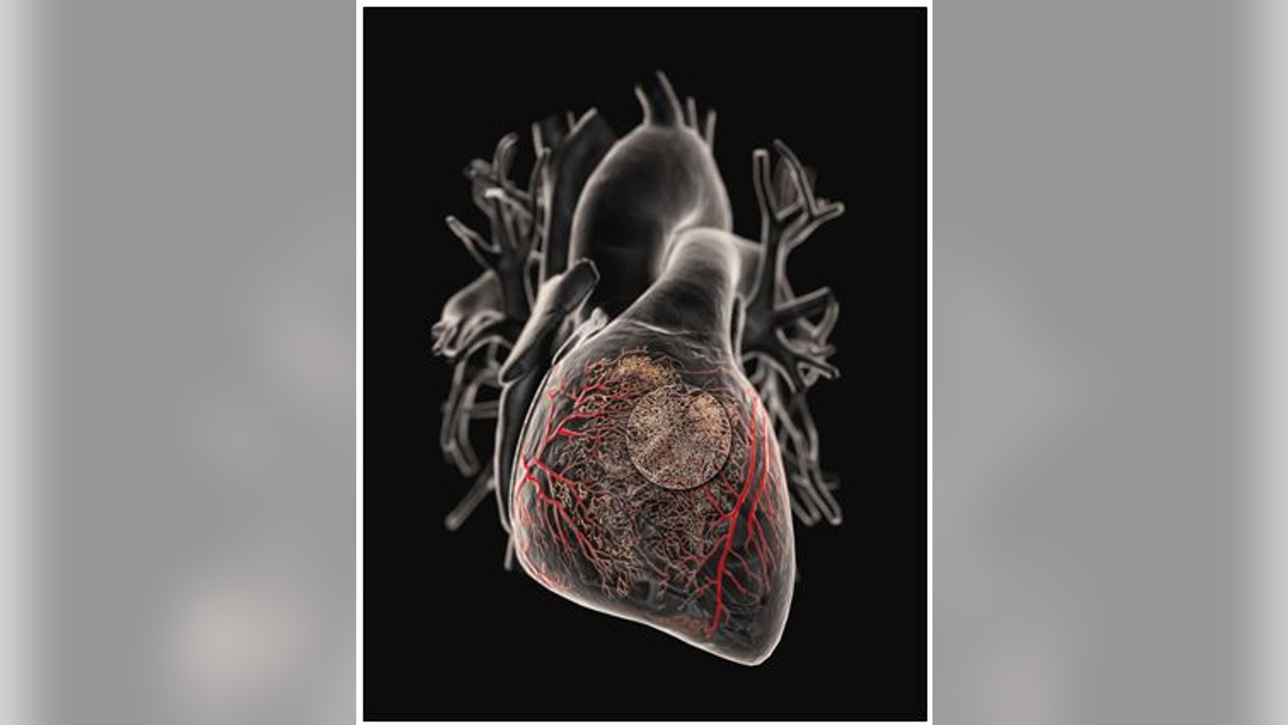 Doctors delivery gene-therapy products directly to the heart.