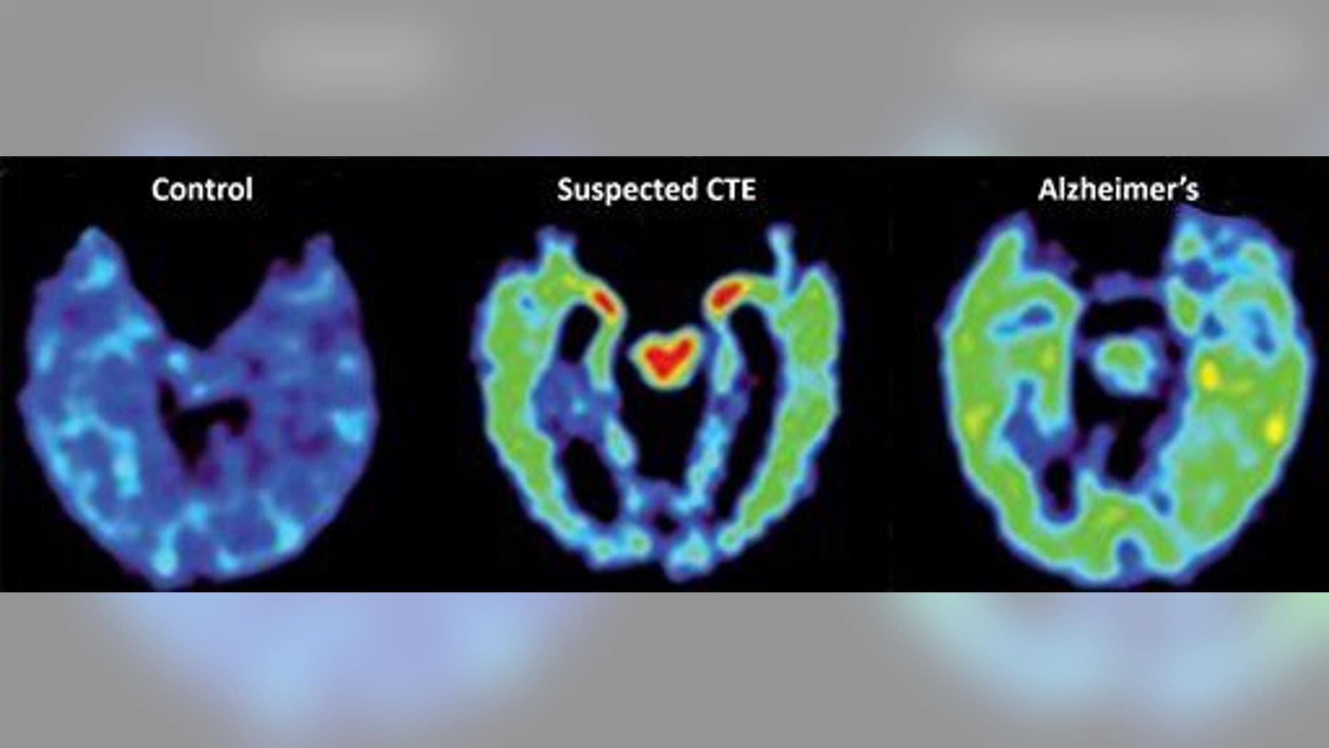 Scans of a normal brain, a brain with suspected CTE, and a brain affected by Alzheimer's.