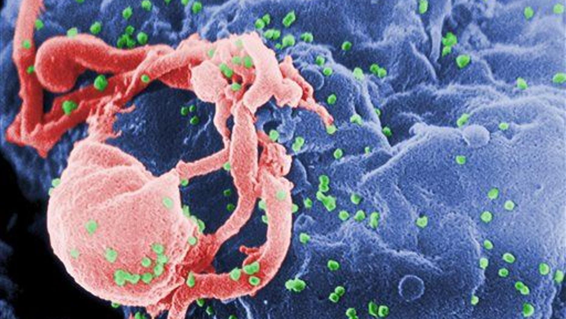 A scanning electron micrograph of multiple round bumps of the HIV-1 virus on a cell surface.