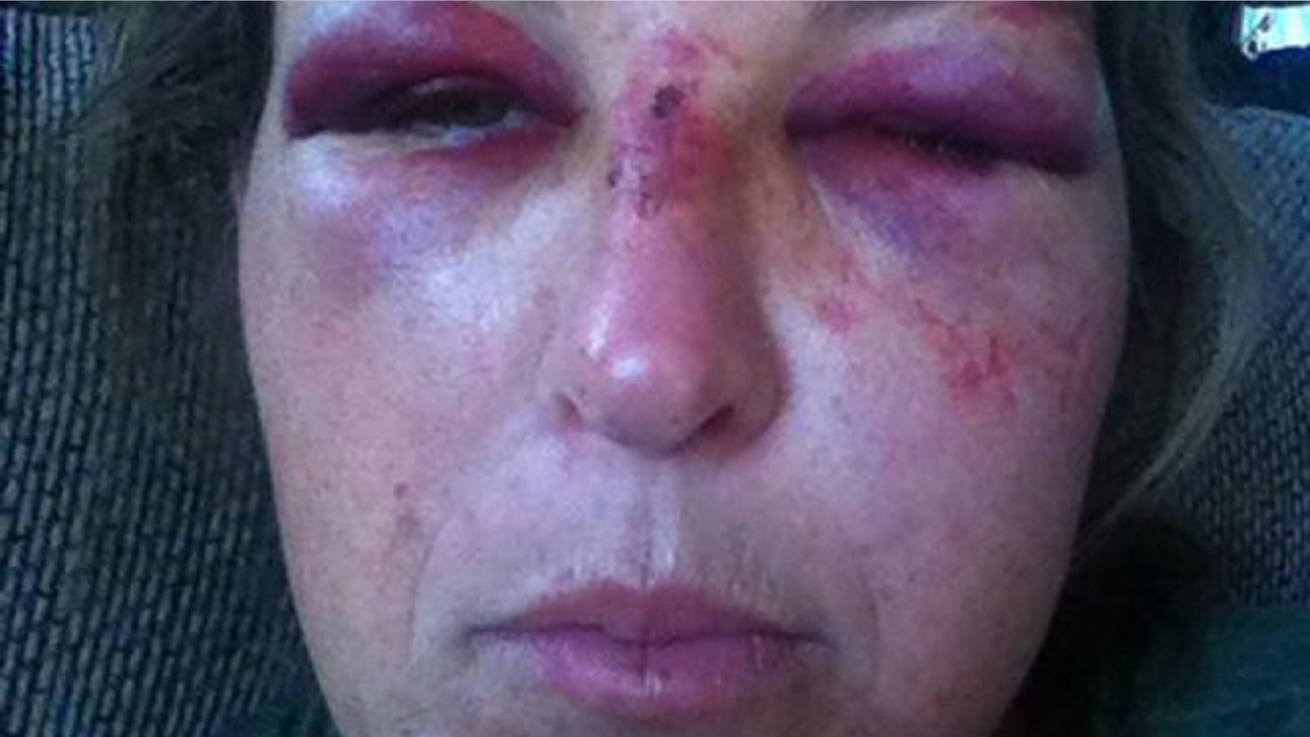 Martha McClure was injured when she was allegedly hit in the face with a shovel.