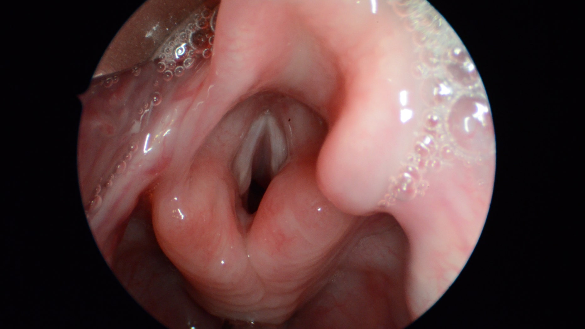 In this photo provided by J. Scott McMurray Md., Associated Professor, University of Wisconsin School of Medicine and Public Health, taken Oct. 14, 2011, shows a normal larynx and vocal folds, center, during surgery in Madison, Wis. Our voices are the main way we communicate, one we mostly take for granted until something goes wrong. Now researchers have grown human vocal cords in the laboratory, a step toward one day helping to restore a voice to people who have lost theirs to disease or injury. (J. Scott McMurray, Md./University of Wisconsin School of Medicine and Public Health via AP)