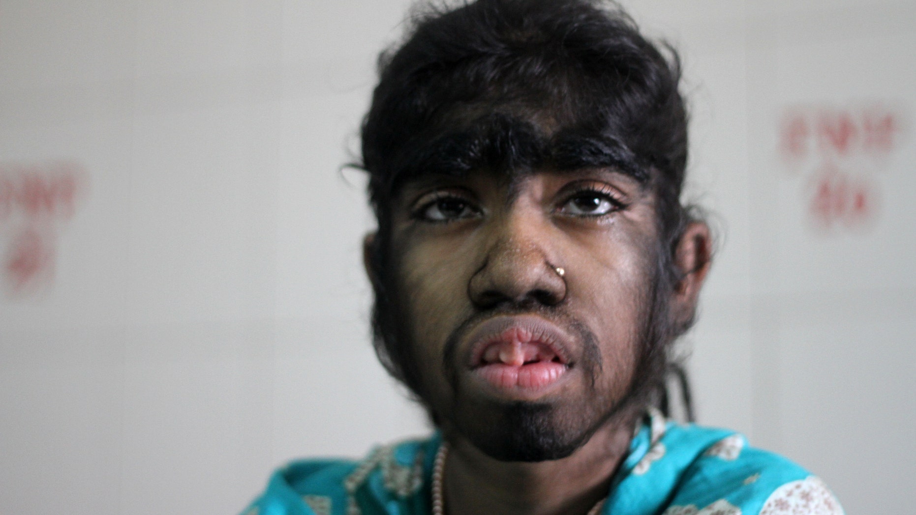 Bithi Aktar, 12, suffers from Werewolf Syndrome.