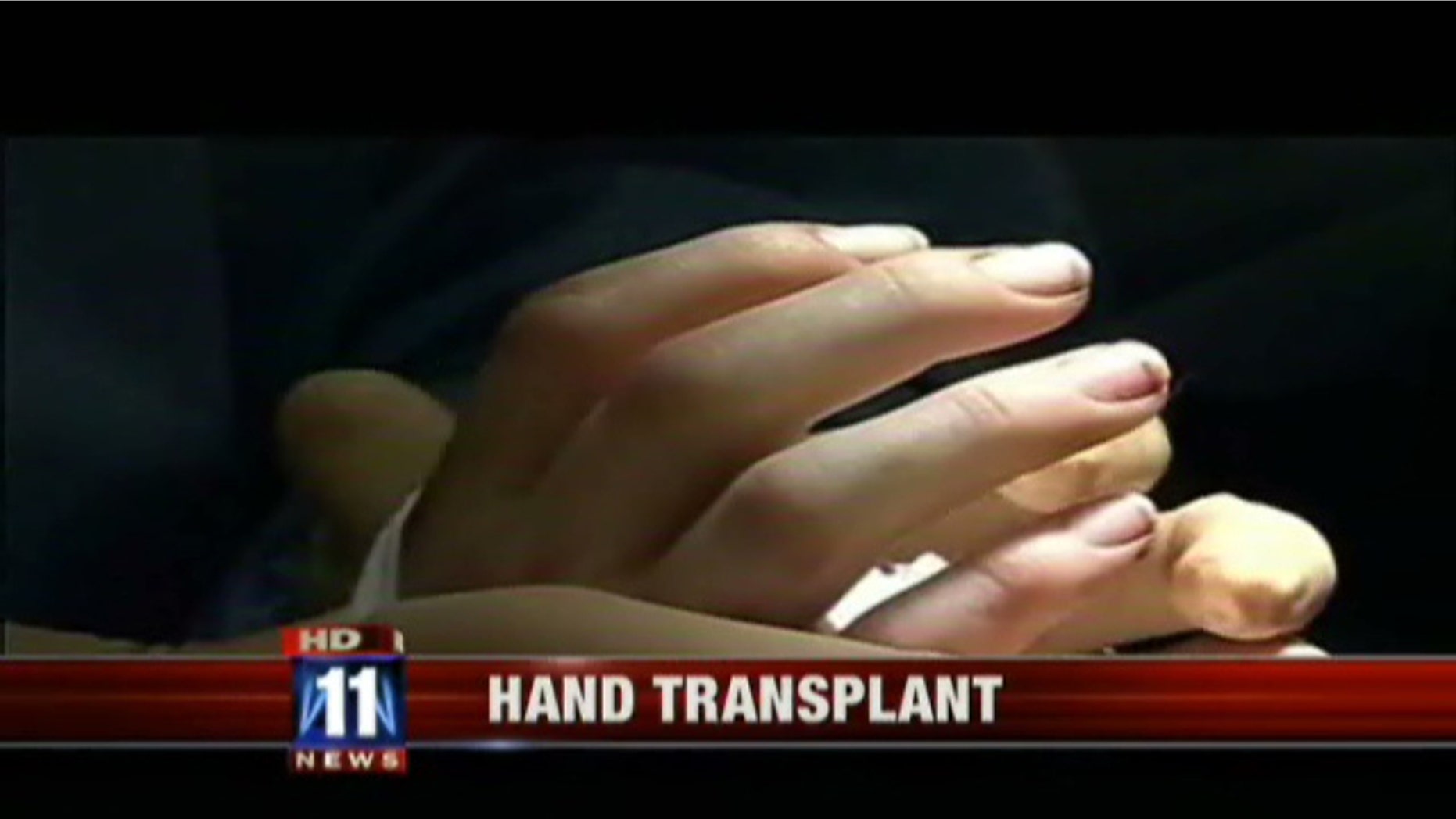 A 26-year-old who lost her right hand in a traffic accident nearly five years ago was the recipient of the first hand transplant in the western United States.