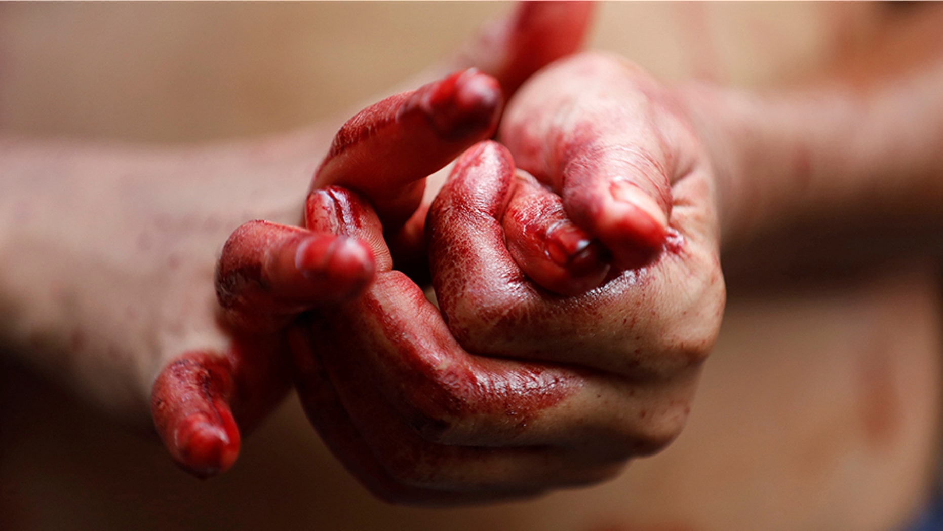 A woman (not pictured) was hospitalized for spontaneously "sweating blood" from her face and palms of her hands, a case report revealed.