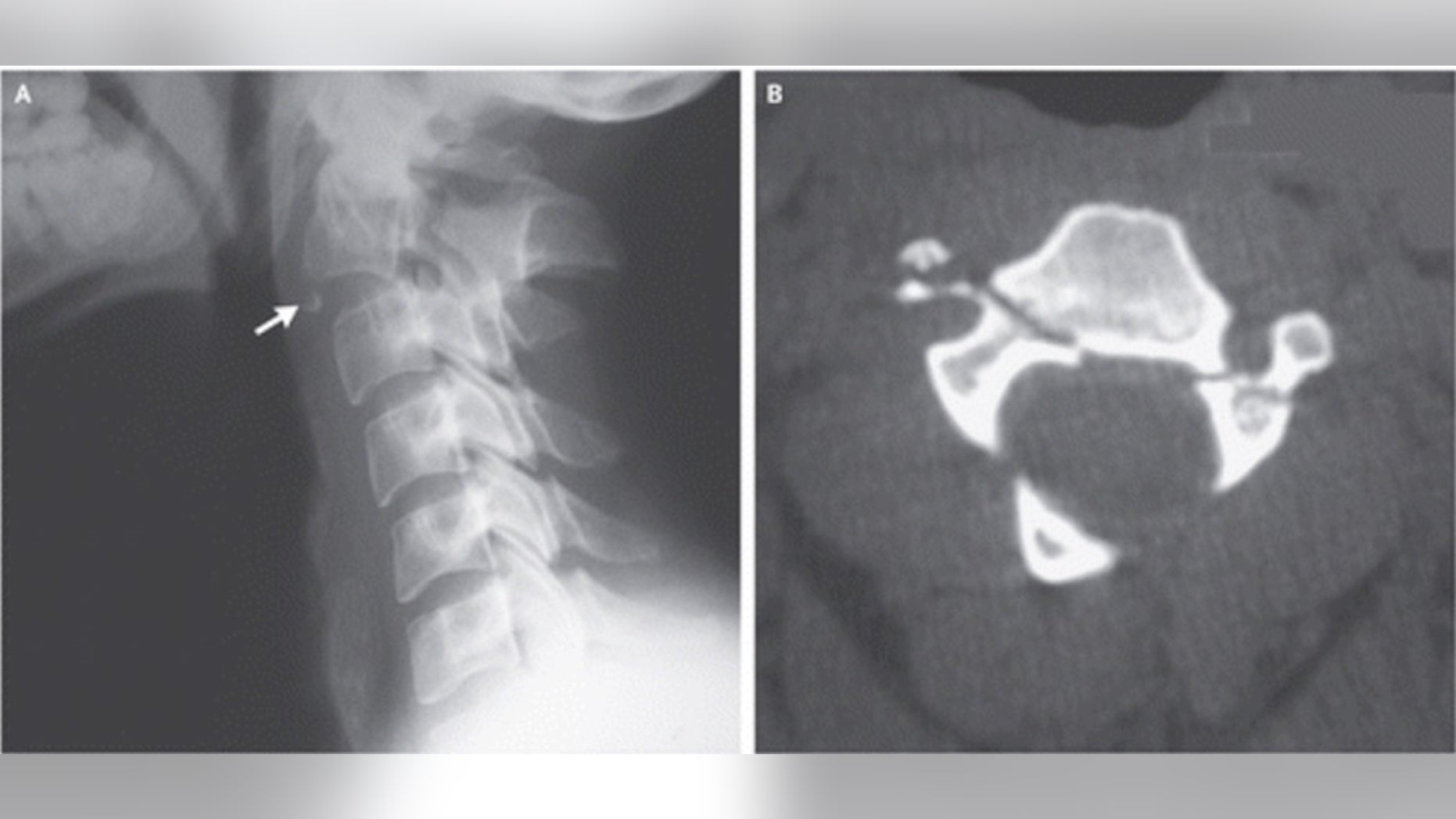 The image on the left is an X-ray of the man's neck. The arrow is pointing to a small chip of bone that broke off in the injury. The image on the right is a CT scan, looking up at the vertebra. There are two fractures, one on the right side and one on the left side.