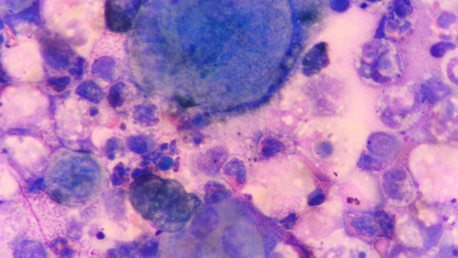 multinucleated giant