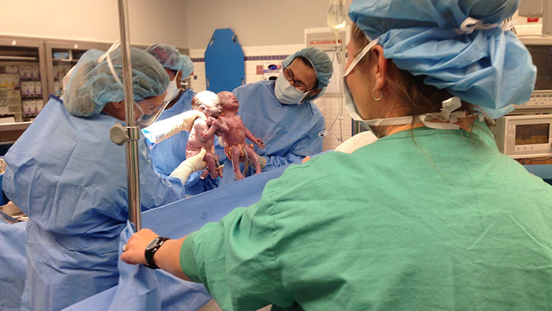 Jenna and Jillian were born holding hands two years ago.