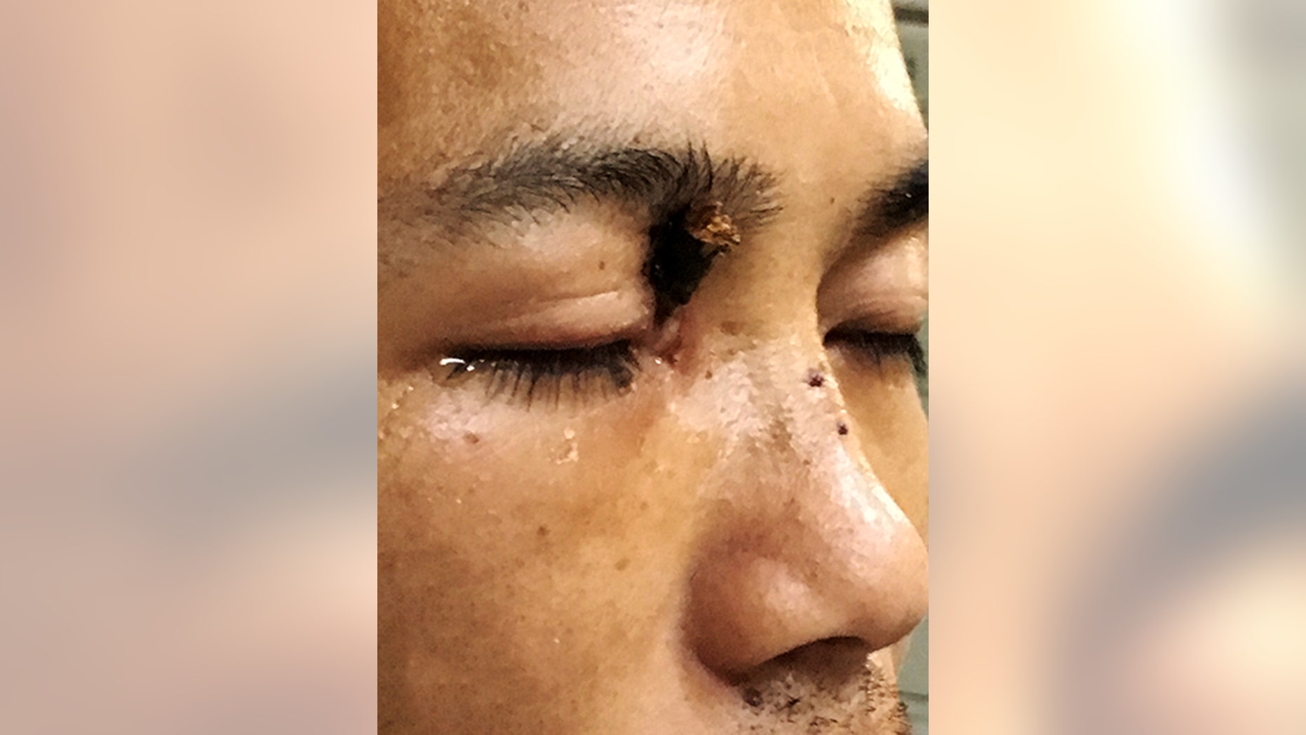 Doctors in China have pulled a 7-inch tree branch from Wu Xuan's injured right eye.