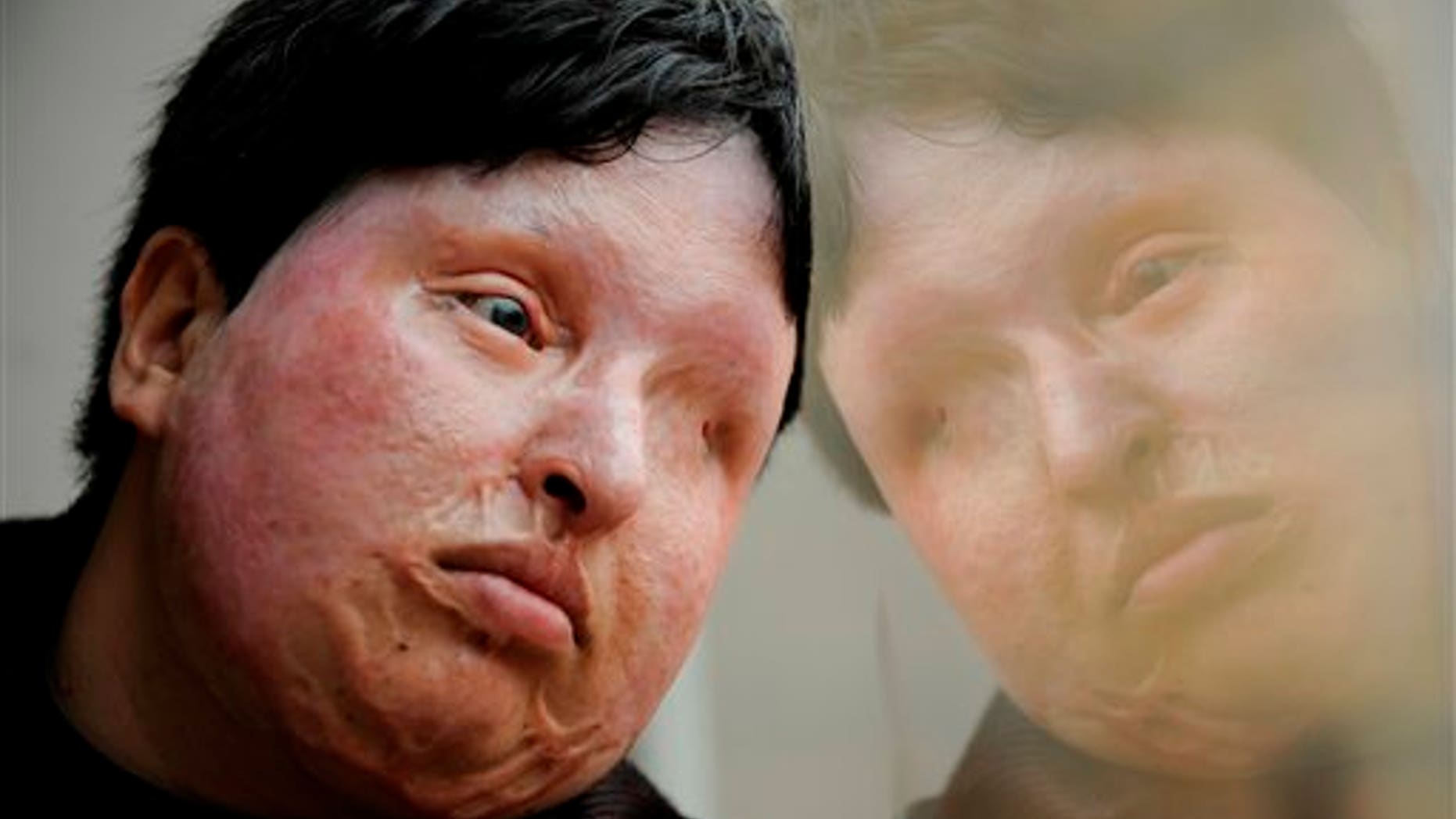 In this March 4, 2009 file photo, Ameneh Bahrami, who was blinded and disfigured by a man who poured acid on her face in 2004 for rejecting his marriage proposal, poses for a portrait at a hospital in Barcelona, Spain.