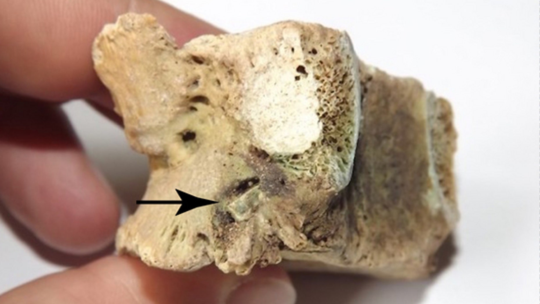 The remains of an Iron Age warrior, who survived in spite of a bronze arrowhead (see pointer) embedded in his vertebra.