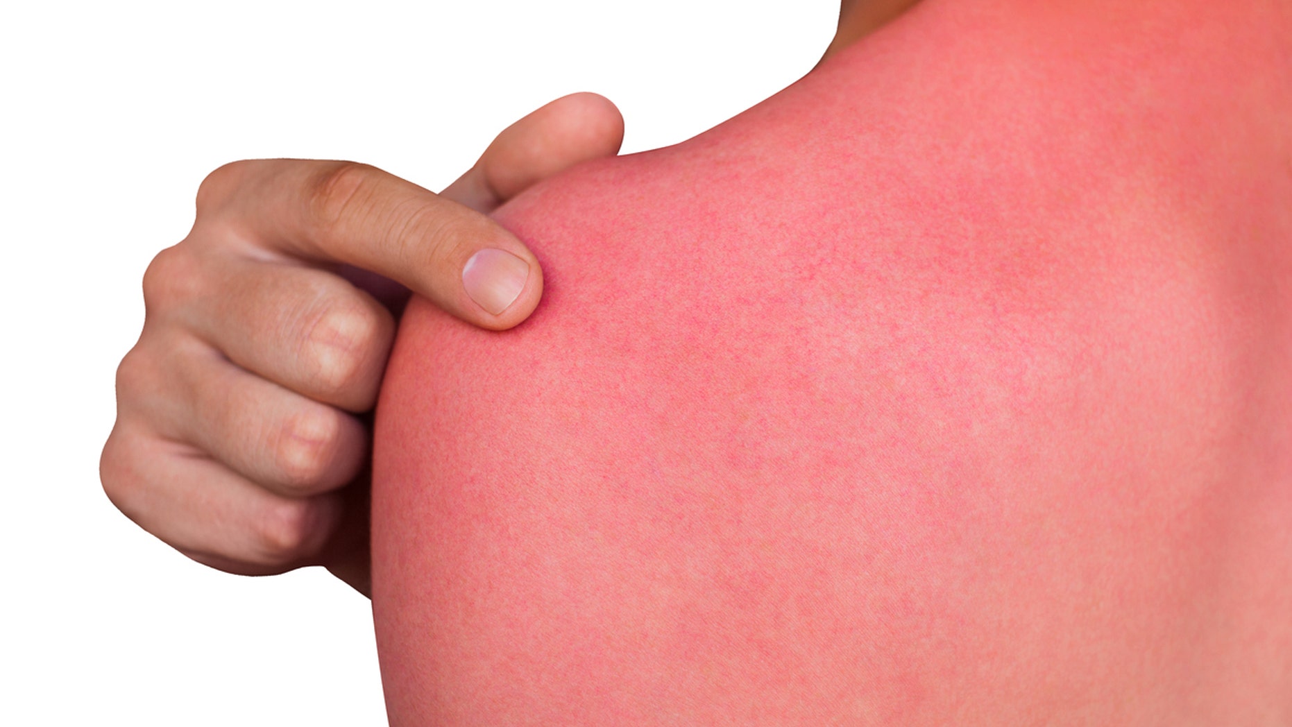 Cindie Allen-Stewart, of Mount Calm, Texas, stands by her sunburn soothing hack, which she shared on Facebook June 22.