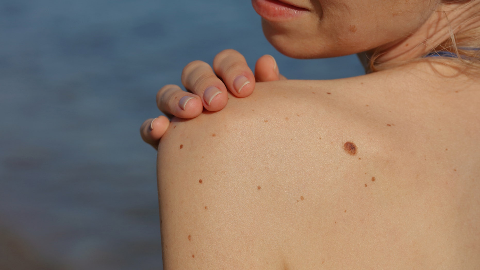 A woman is using her unusual skin condition to educate and promote awareness.