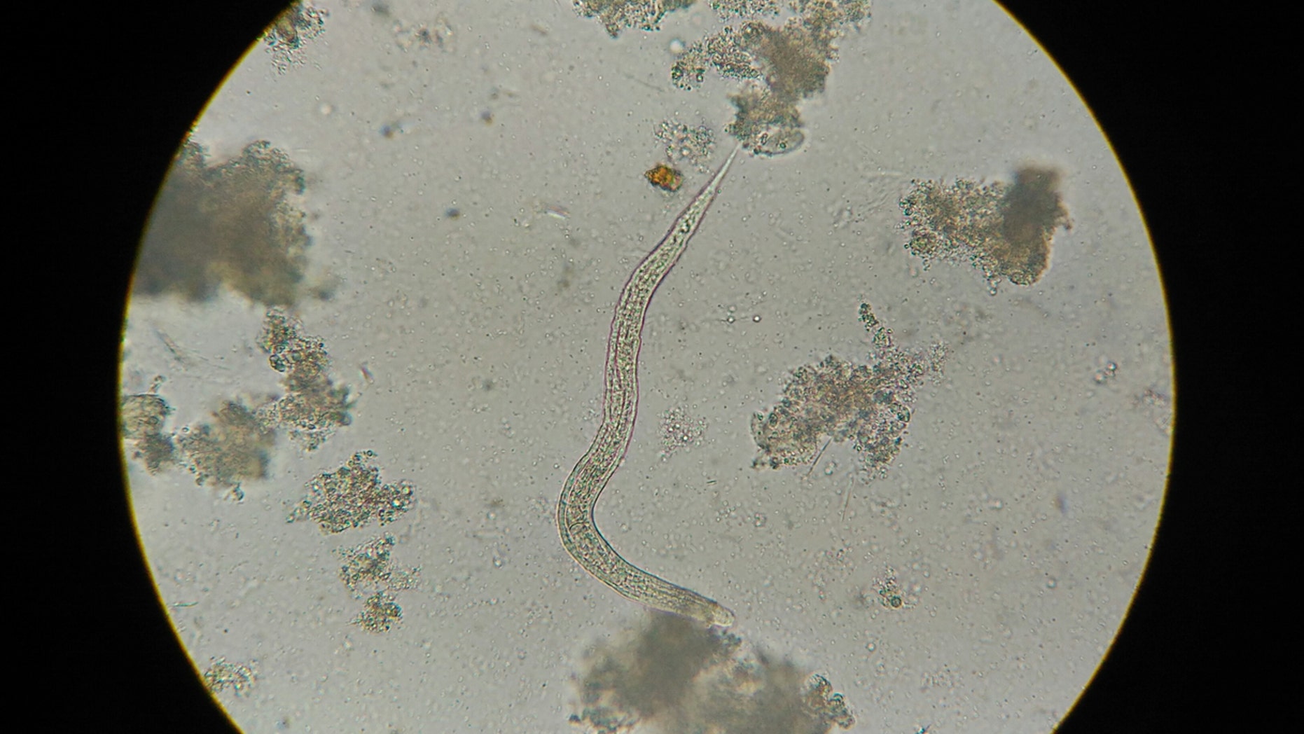 Florida man Sam Cordero blamed his Christmas ham feast for giving him the pork parasite -- a brain-eating tapeworm that lodged itself in his eye.