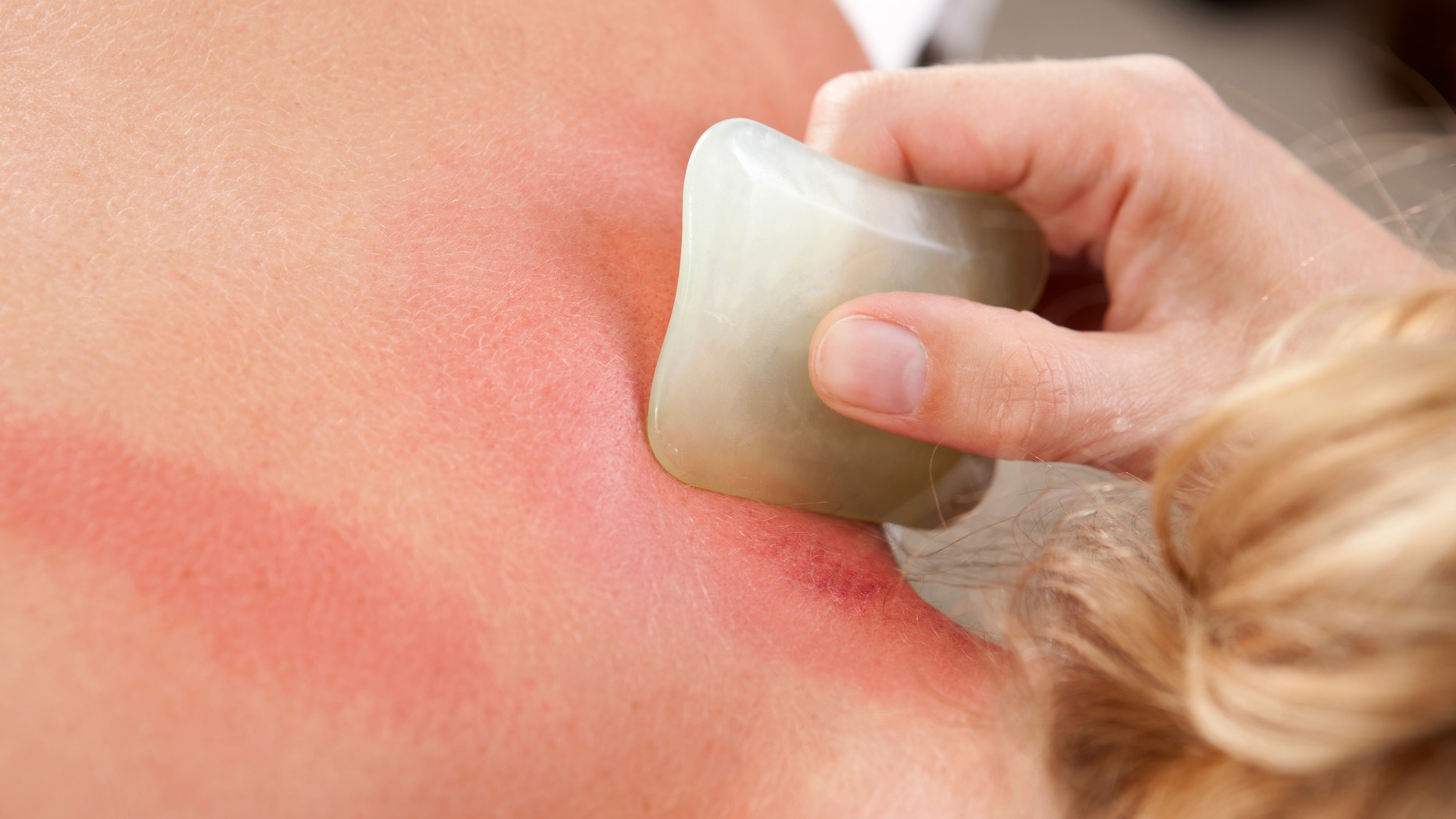 Detail showing redness on skin during a gua sha acupuncture treatment