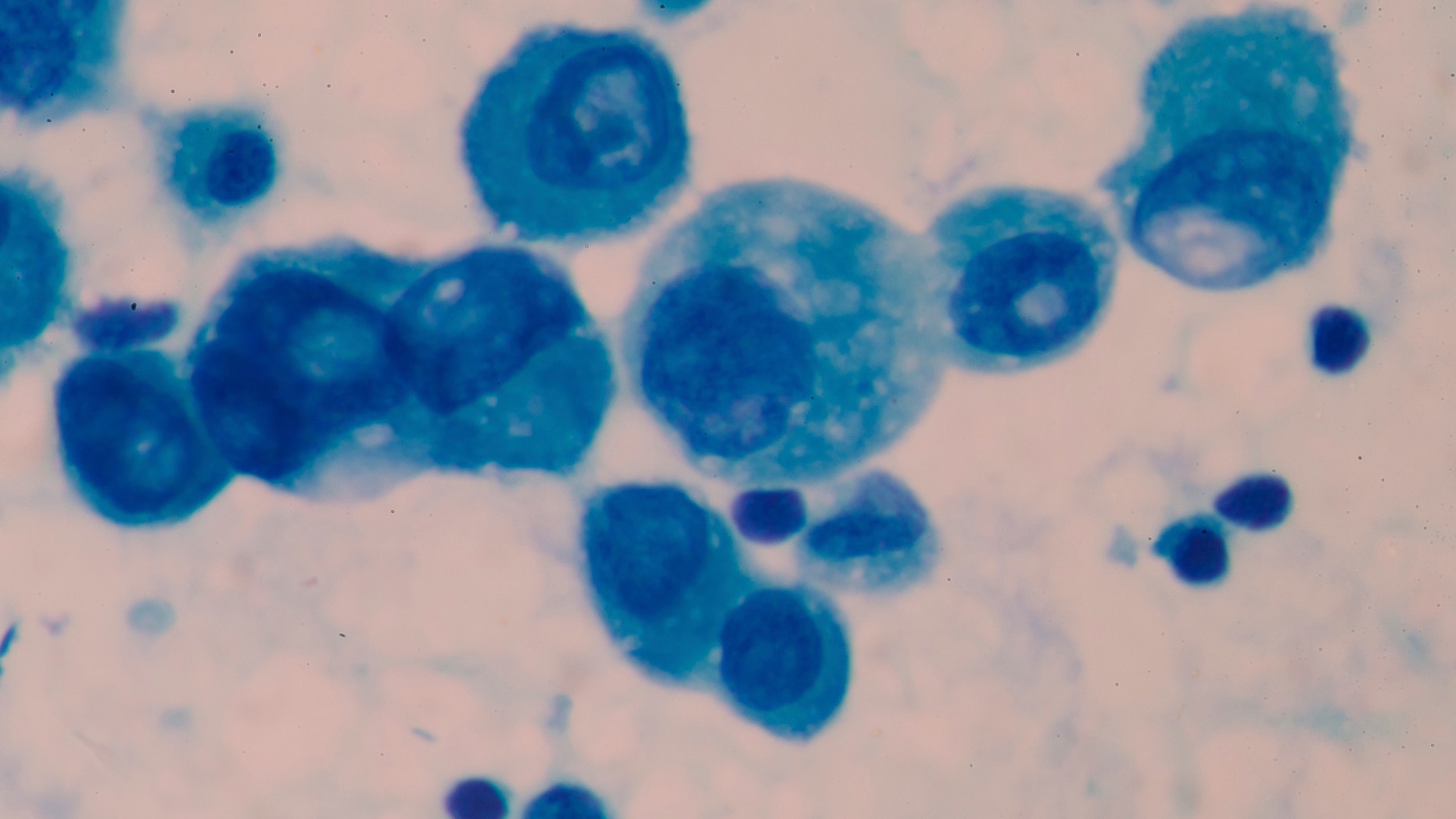 Cancer Cell in blood cells human showing abnormal cells.