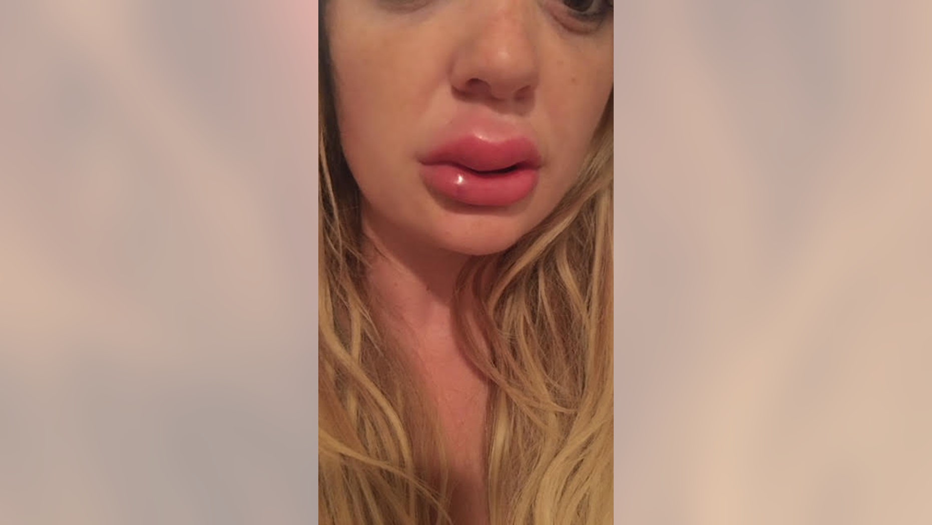 Jessica Bennett said she is not opposed to seeking additional fillers, but cautions others to investigate who is performing the procedure.