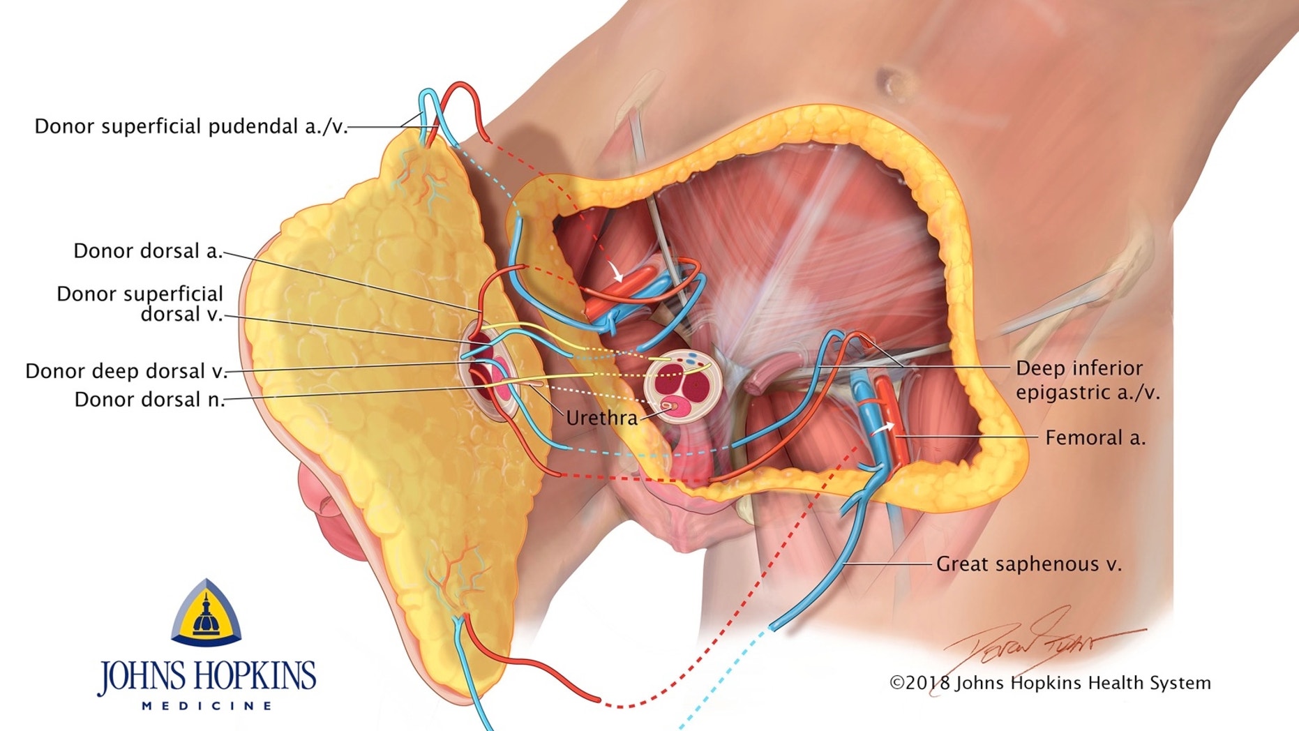 Saying they wanted to address "an unspoken injury of war," Johns Hopkins University surgeons rebuilt the man's entire pelvic region — transplanting a penis, scrotum and part of the abdominal wall from a deceased donor — in a highly experimental 14-hour operation last month.
