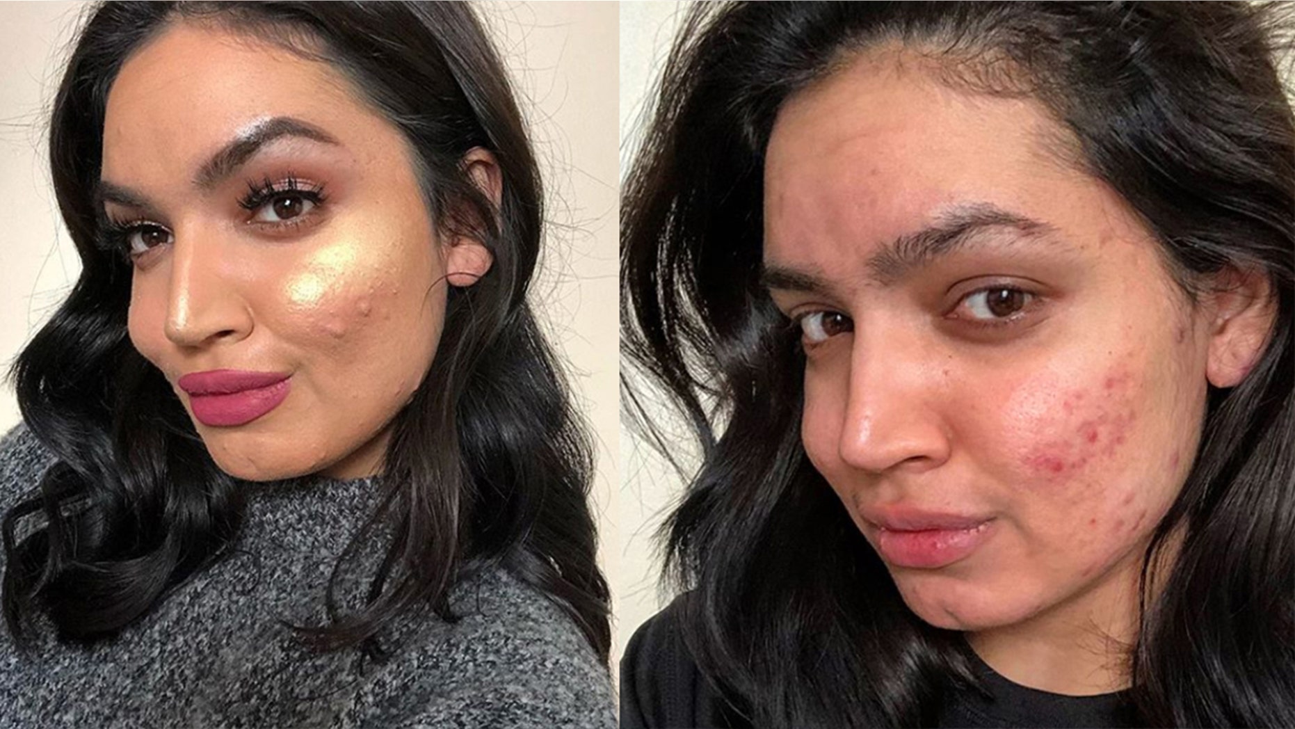 One beauty blogger is speaking out against L'Oréal, claiming that the cosmetic giant booked and then dropped her due to her “skin issues."
