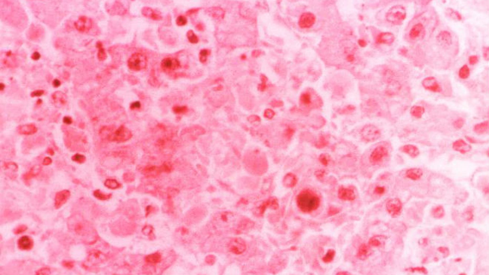 This hematoxylin-eosin-stained (H&E) photomicrograph depicts the cytoarchitectural changes found in a liver tissue specimen extracted from a Lassa fever patient.