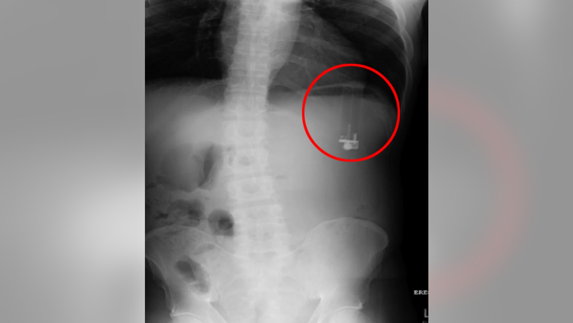 An X-ray revealed the upside-down lighter in the man's abdomen.
