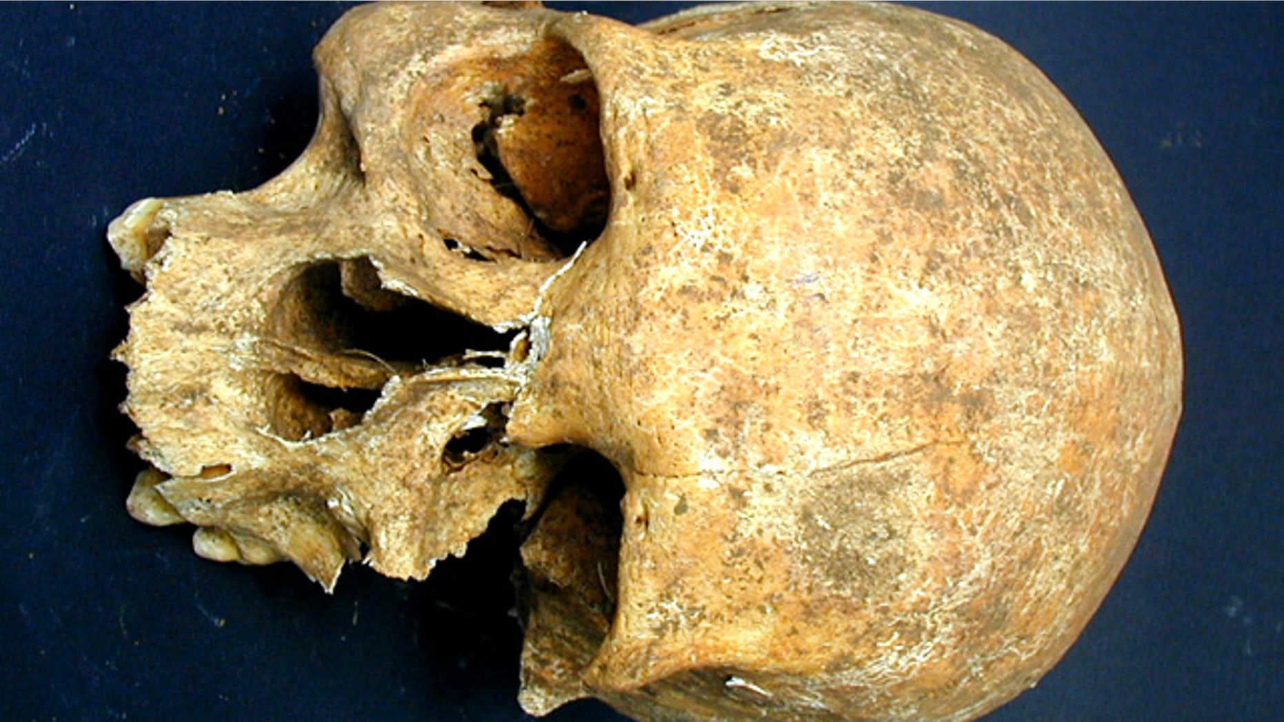Bone wasting reveals the owner of this skull to have suffered from leprosy. An unhealed gash on the forehead suggests that the man died a violent death, perhaps in battle.