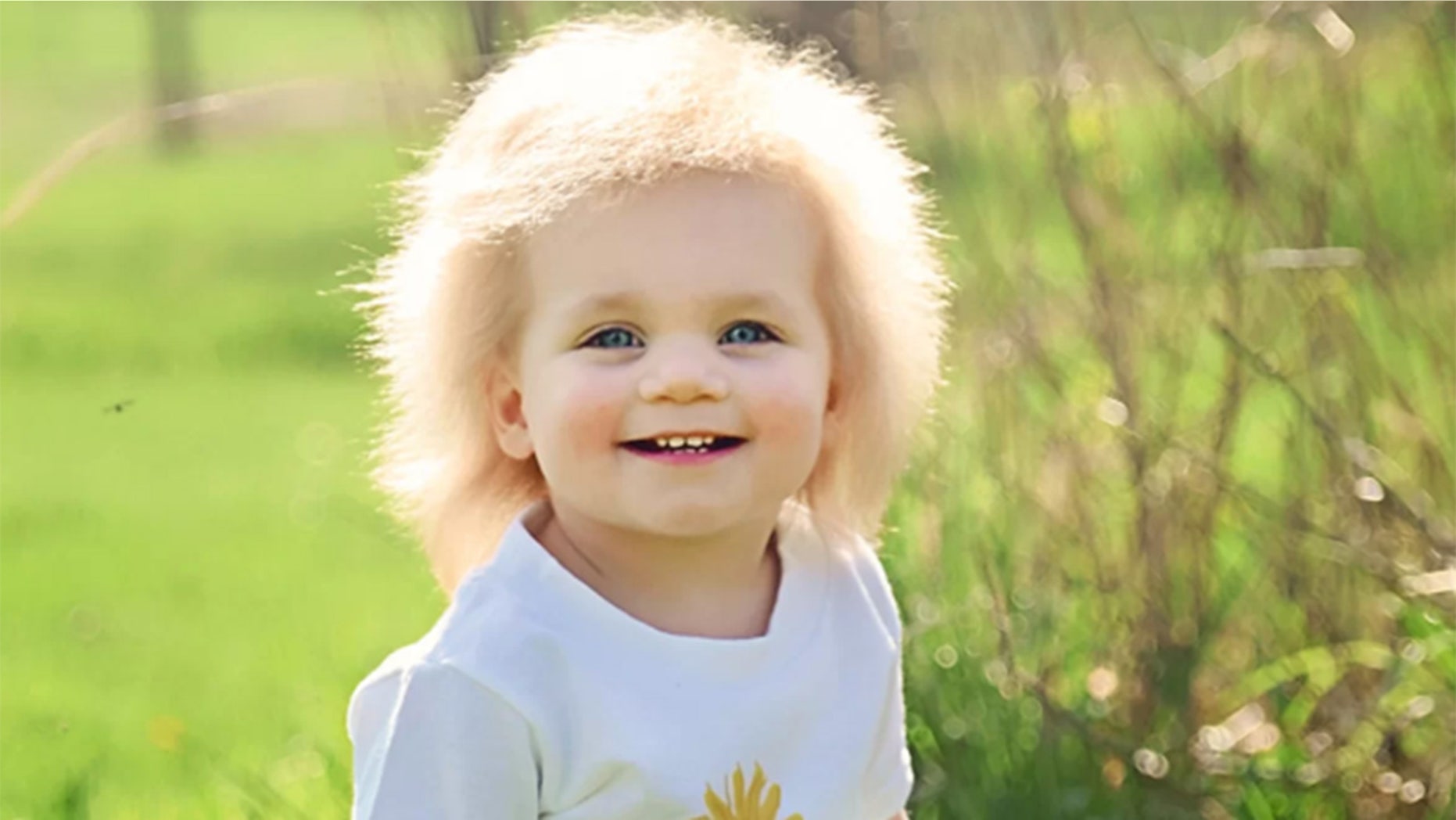 What Causes Uncombable Hair Syndrome Fox News