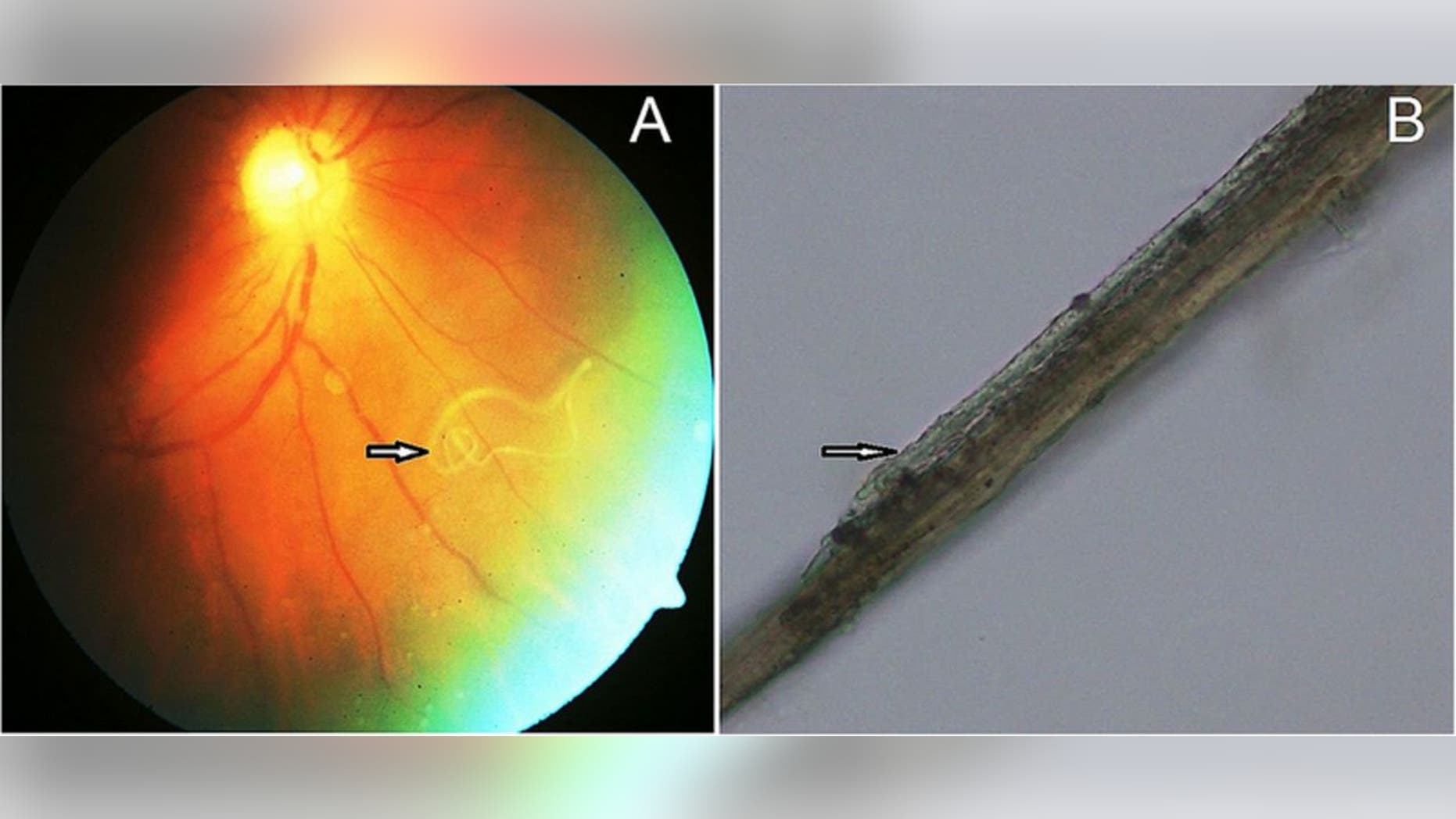 (Left) Showing the coiled Loa loa worm clearly visible in the fundus photo (arrow). (Right) Transparent tubular body of the worm under high microscopic magnification after removal through vitrectomy for microbiological examination. Image courtesy Dr. Bhagabat Nayak.