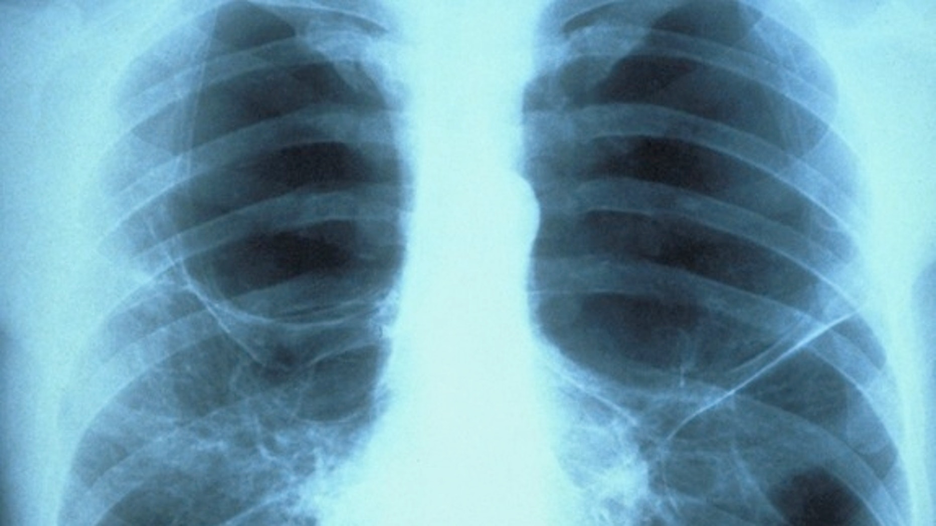 Lung cancer cases on the rise in non-smokers, study suggests | Fox News