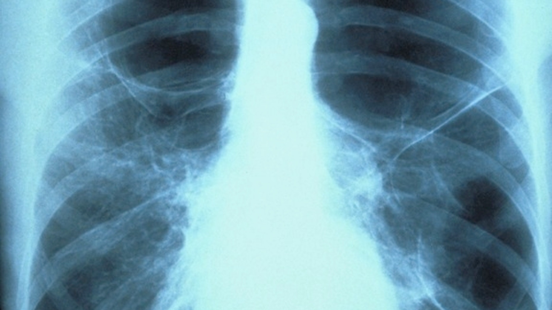 X-ray of lungs showing emphysema bubbles in the left lung. Emphysema is a permanent enlargement of the alveoli and deterioration of the alveolar walls. Cigarette smoking is the most common cause of emphysema, though some cases seem to be hereditary.
(c) GJLP