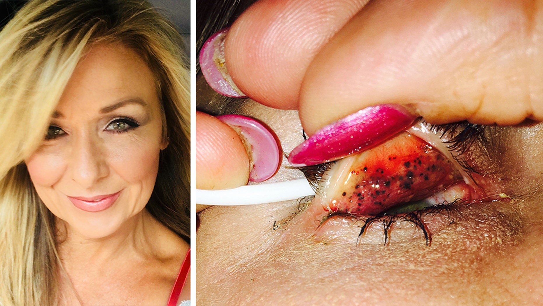 Theresa Lynch, 50, left her mascara on for 25 years and a doctor discovered something shocking underneath her eyelids. Now, Lynch is warning others to "properly take your makeup off every single night."