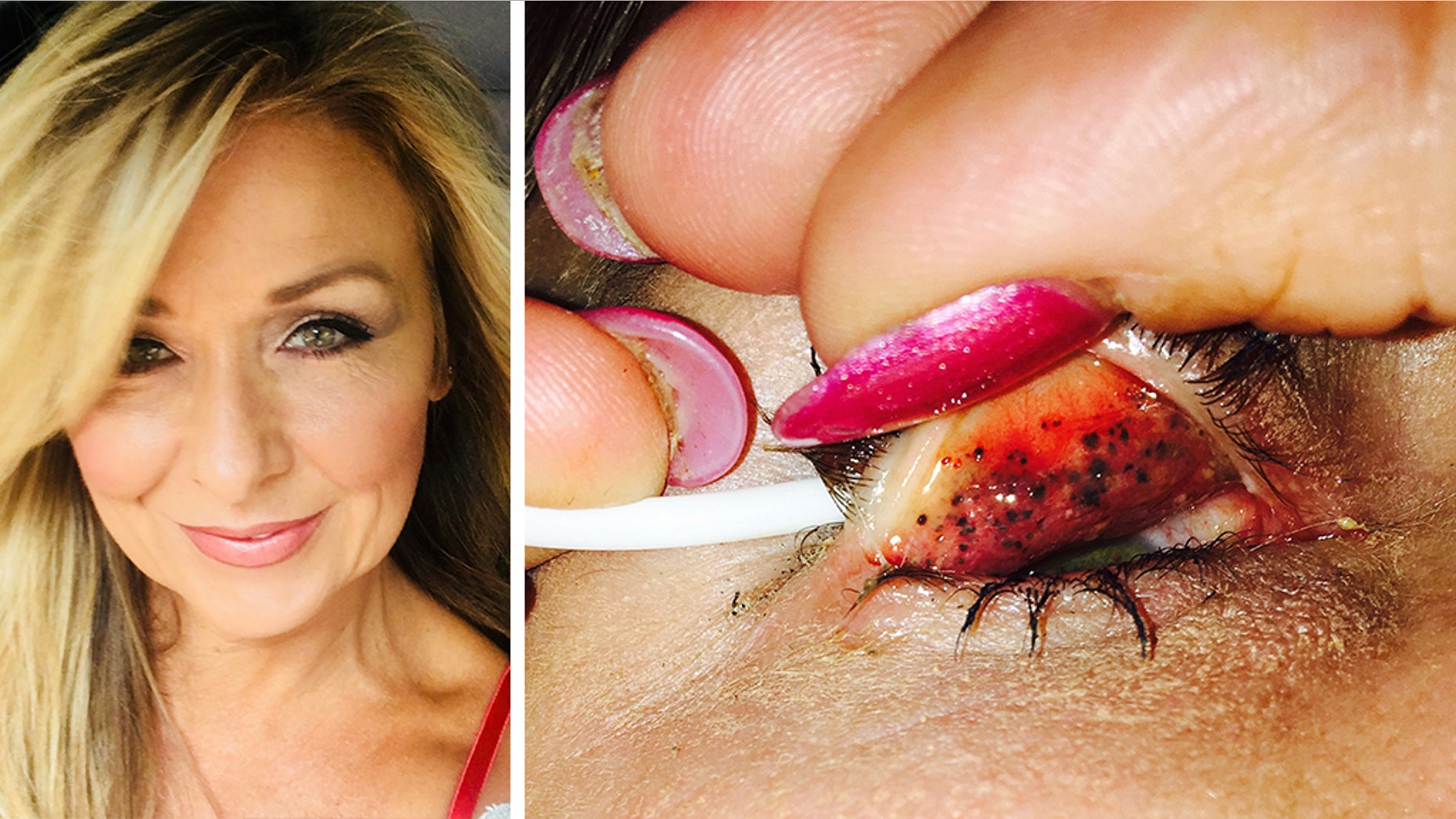 Theresa Lynch, 50, left her mascara on for 25 years and a doctor discovered something shocking underneath her eyelids. Now, Lynch is warning others to "properly take your makeup off every single night."